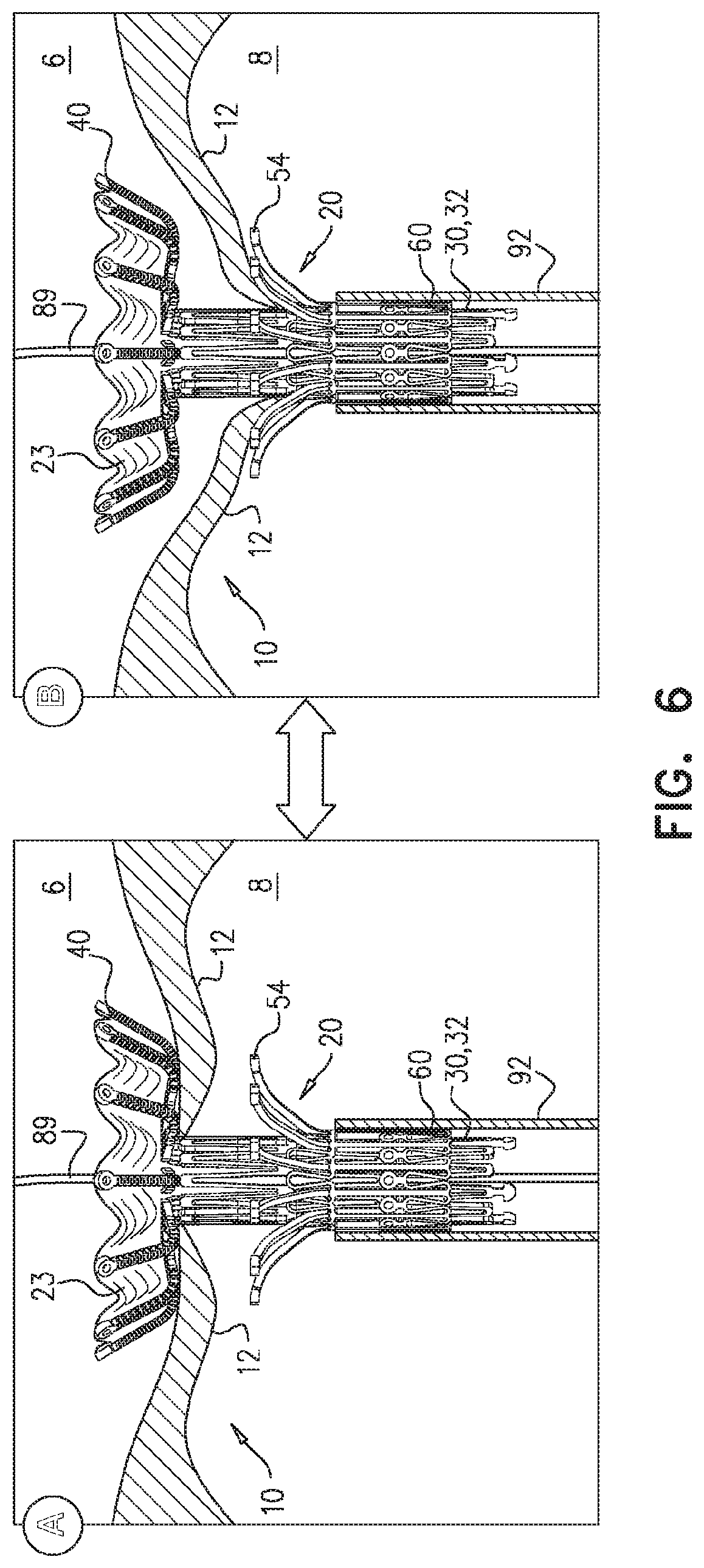 Patent US11779458 Figure 11 – Prosthetic valve with leaflet connectors