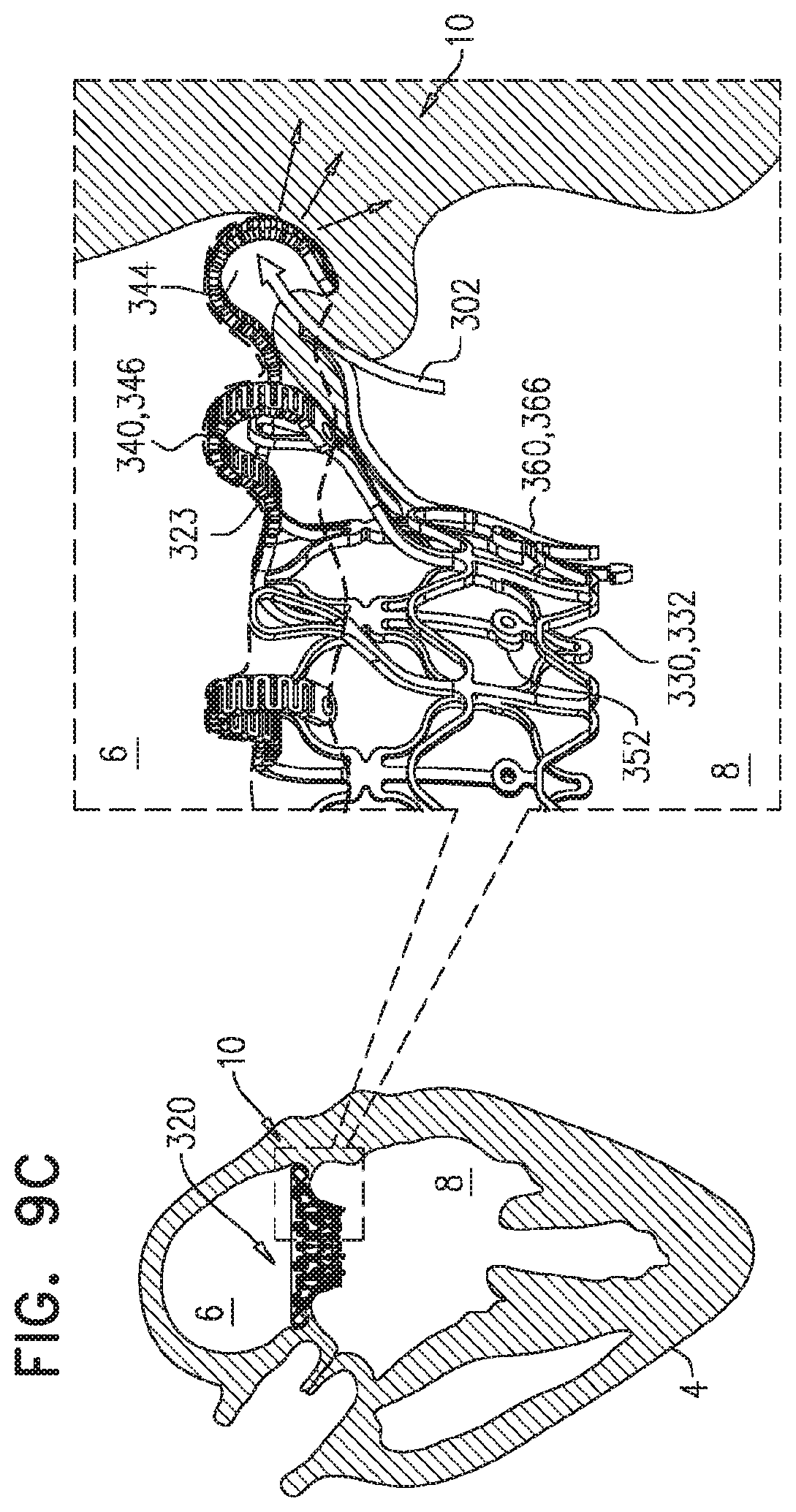 Patent US11779458 Figure 15 – Prosthetic valve with leaflet connectors