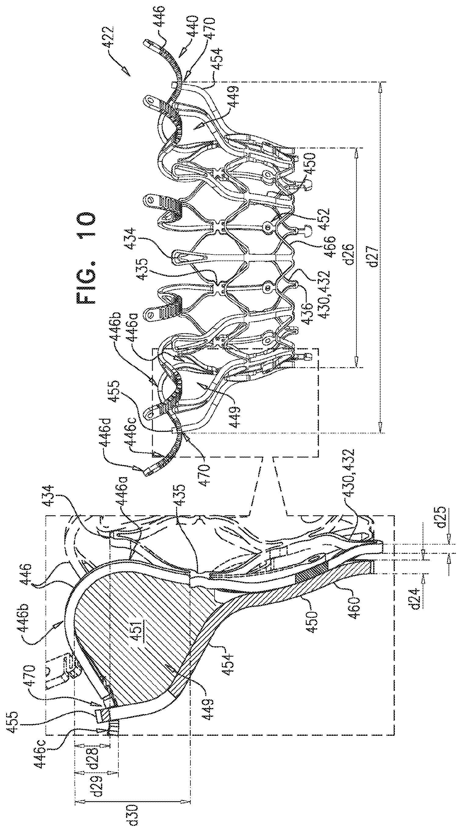 Patent US11779458 Figure 16 – Prosthetic valve with leaflet connectors