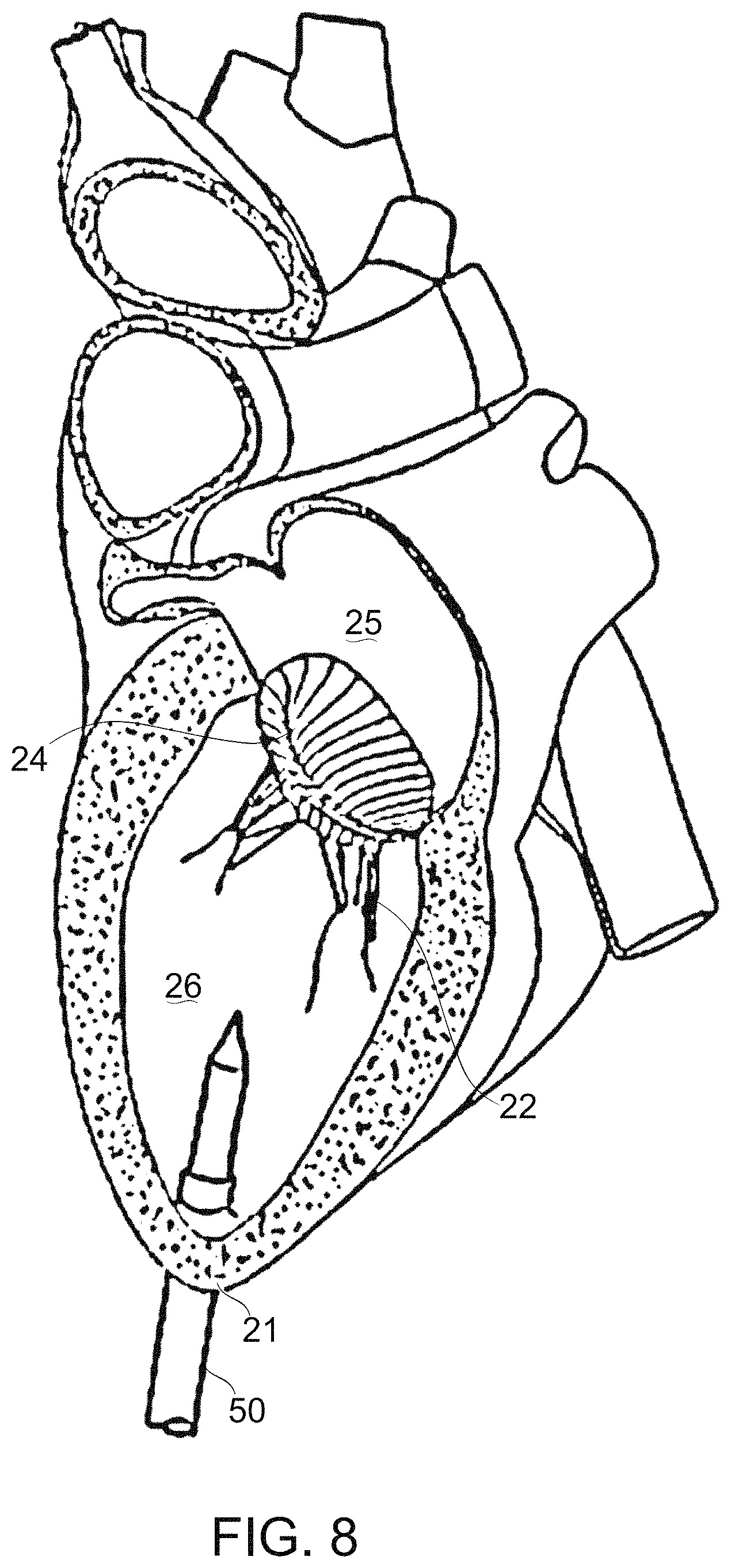 Patent US11779459 Figure 10 – Frame for prosthetic valve