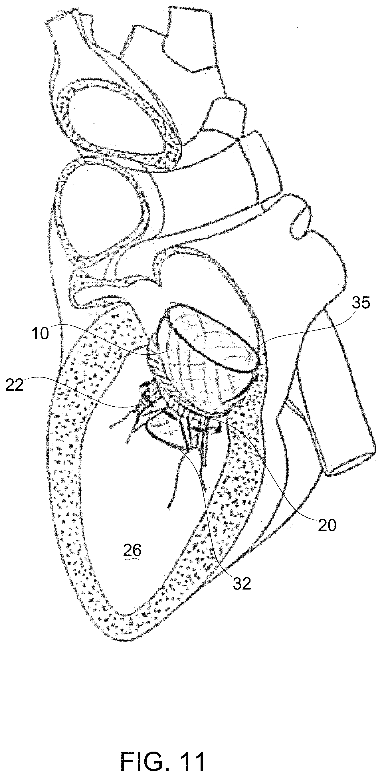 Patent US11779459 Figure 13 – Frame for prosthetic valve