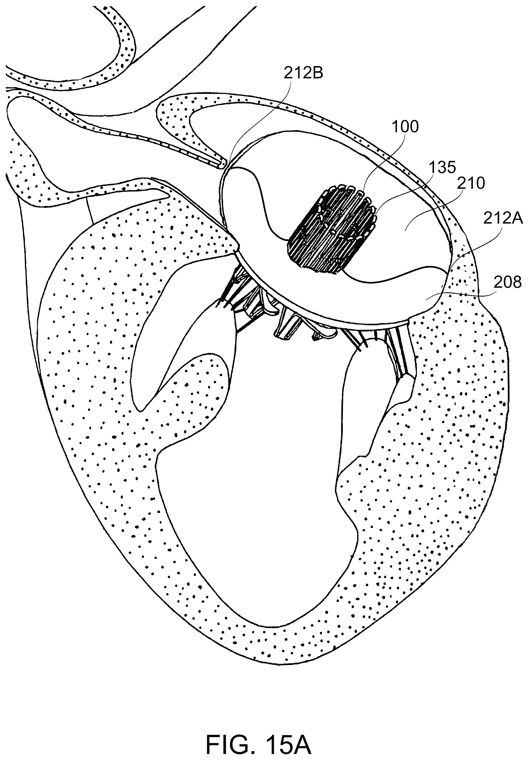 Patent US11779459 Figure 19 – Frame for prosthetic valve