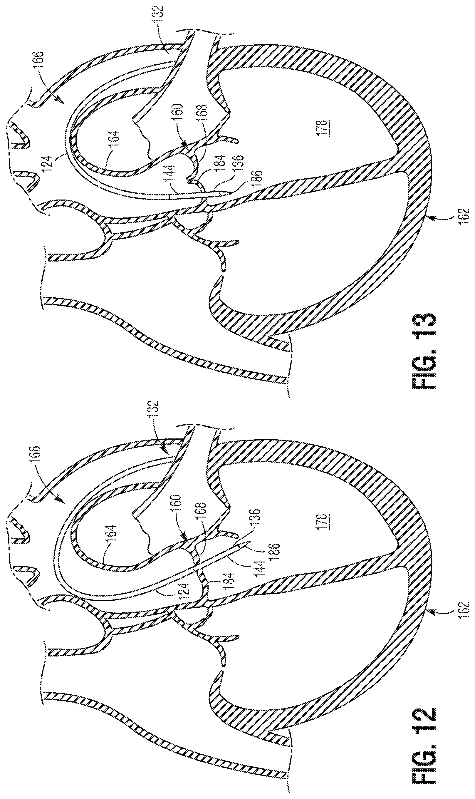 Patent US11779460 Figure 6 – Methods for controlled heart valve delivery