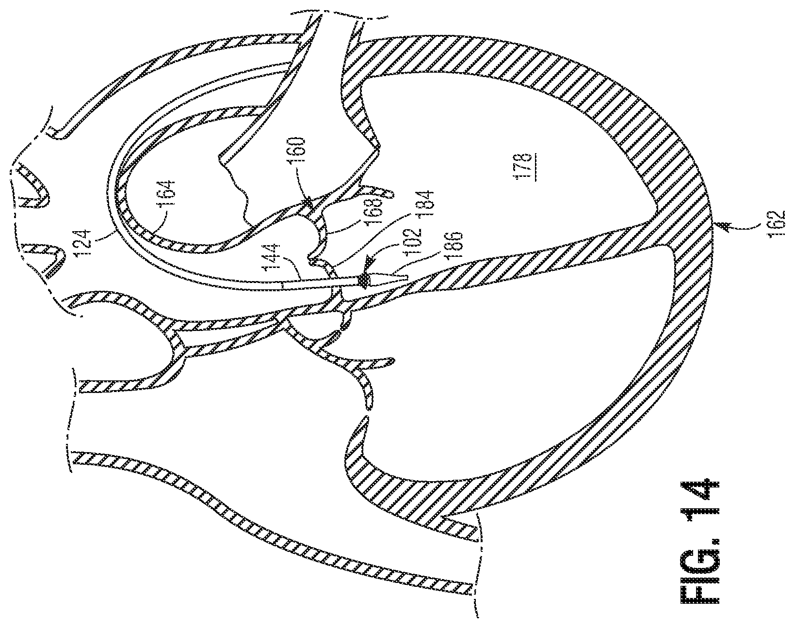 Patent US11779460 Figure 7 – Methods for controlled heart valve delivery