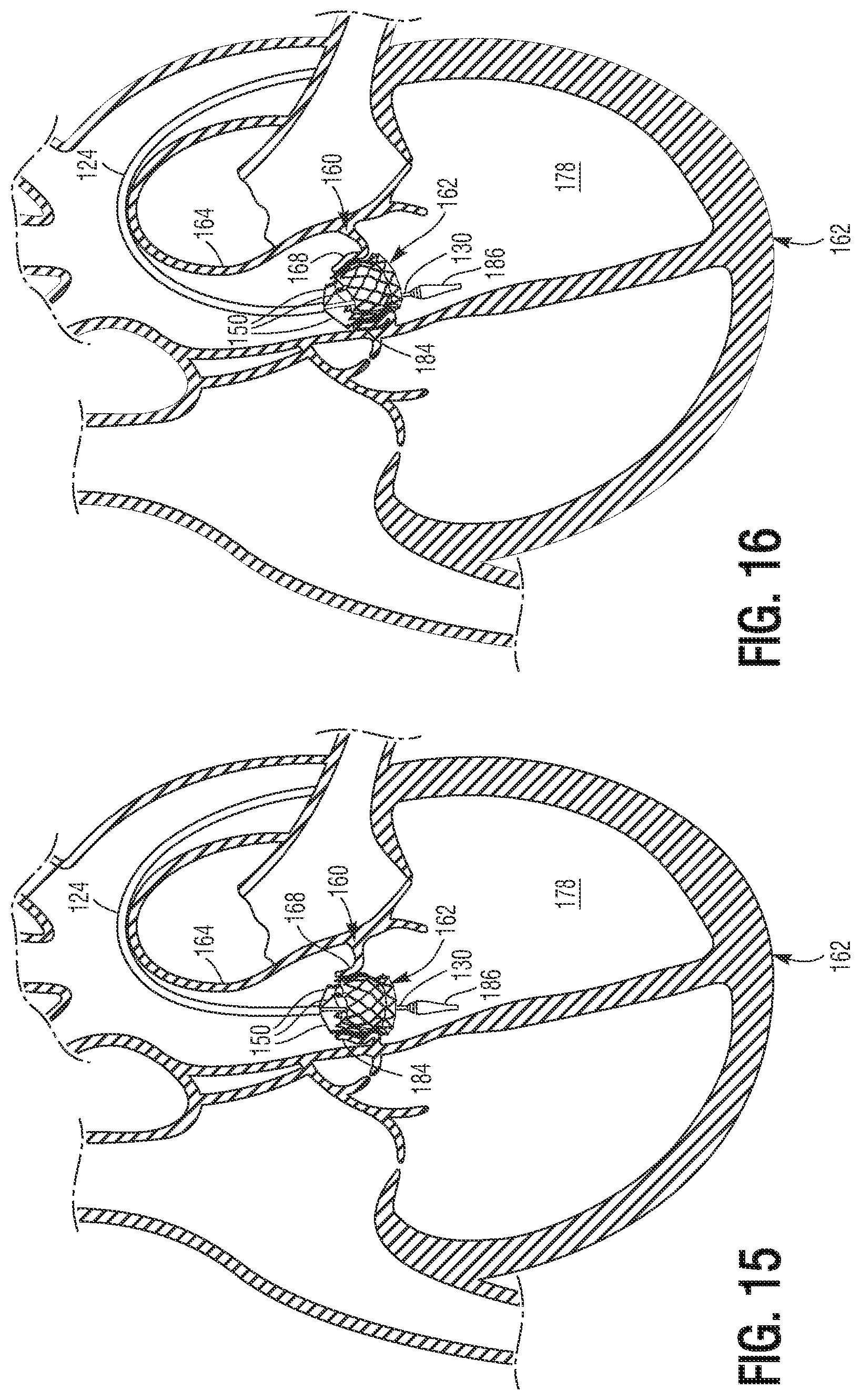 Patent US11779460 Figure 8 – Methods for controlled heart valve delivery