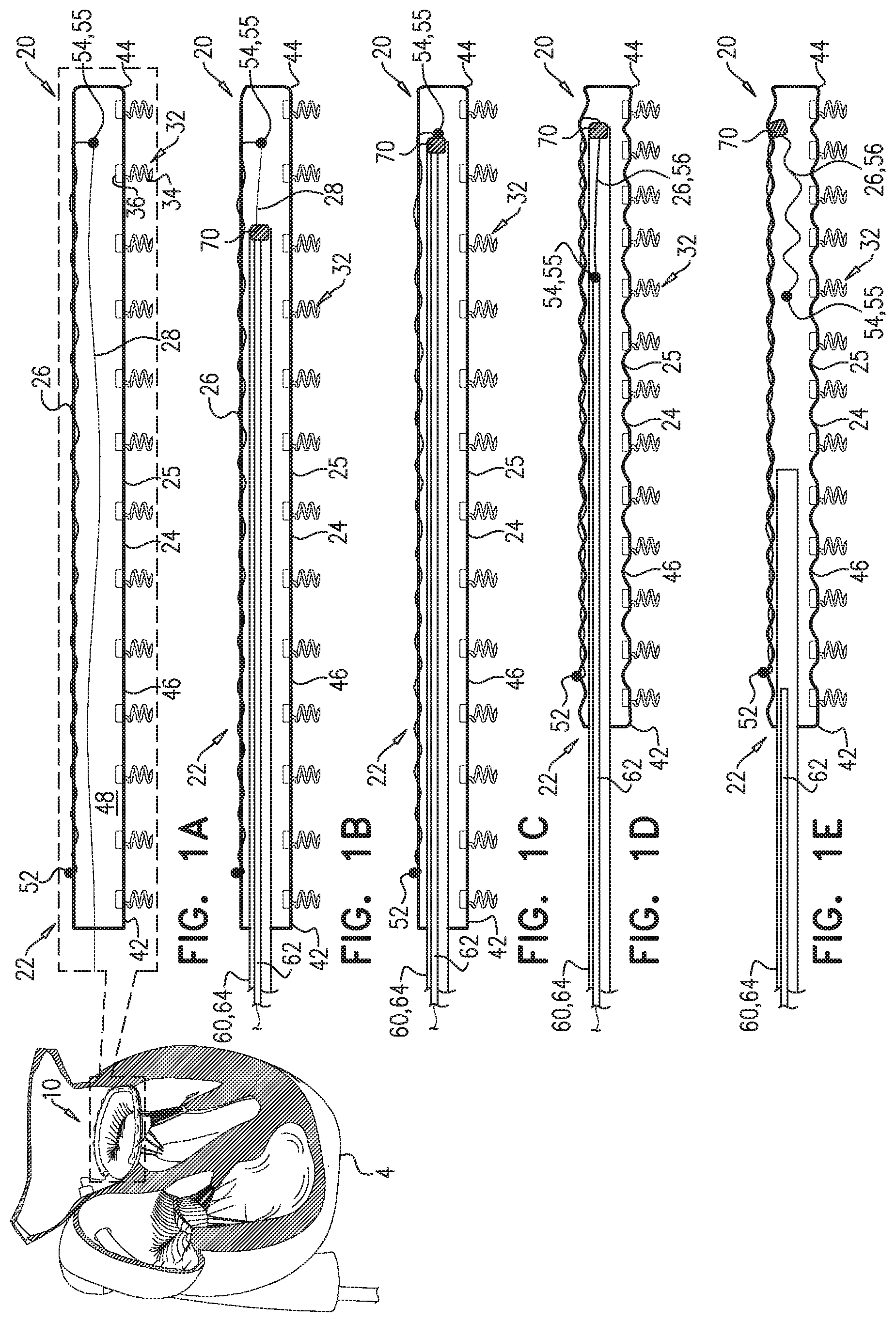 Patent US11779463 Figure 1 – Contraction of an annuloplasty structure