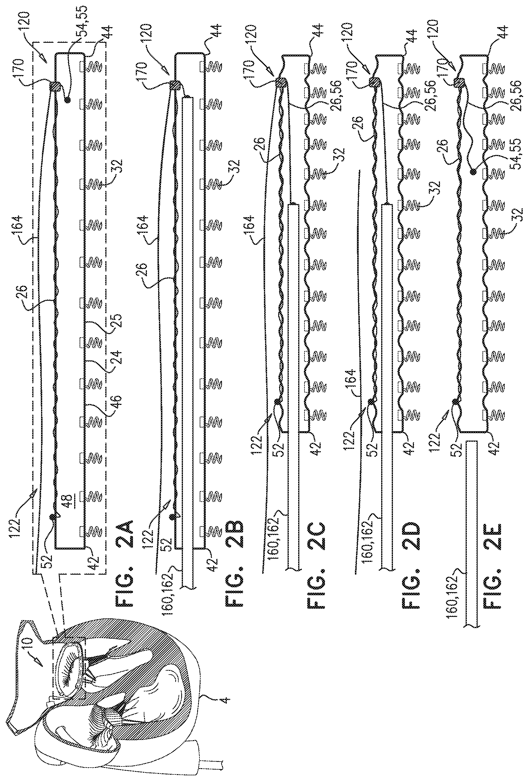 Patent US11779463 Figure 2 – Contraction of an annuloplasty structure