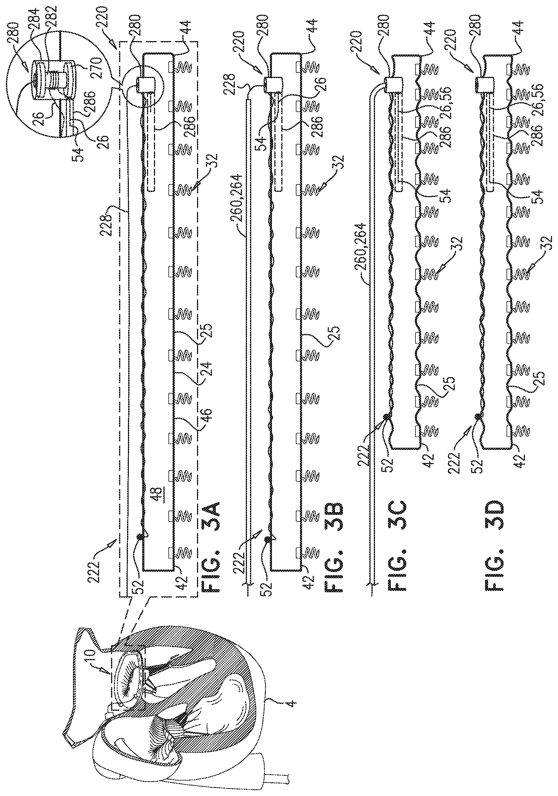 Patent US11779463 Figure 3 – Contraction of an annuloplasty structure
