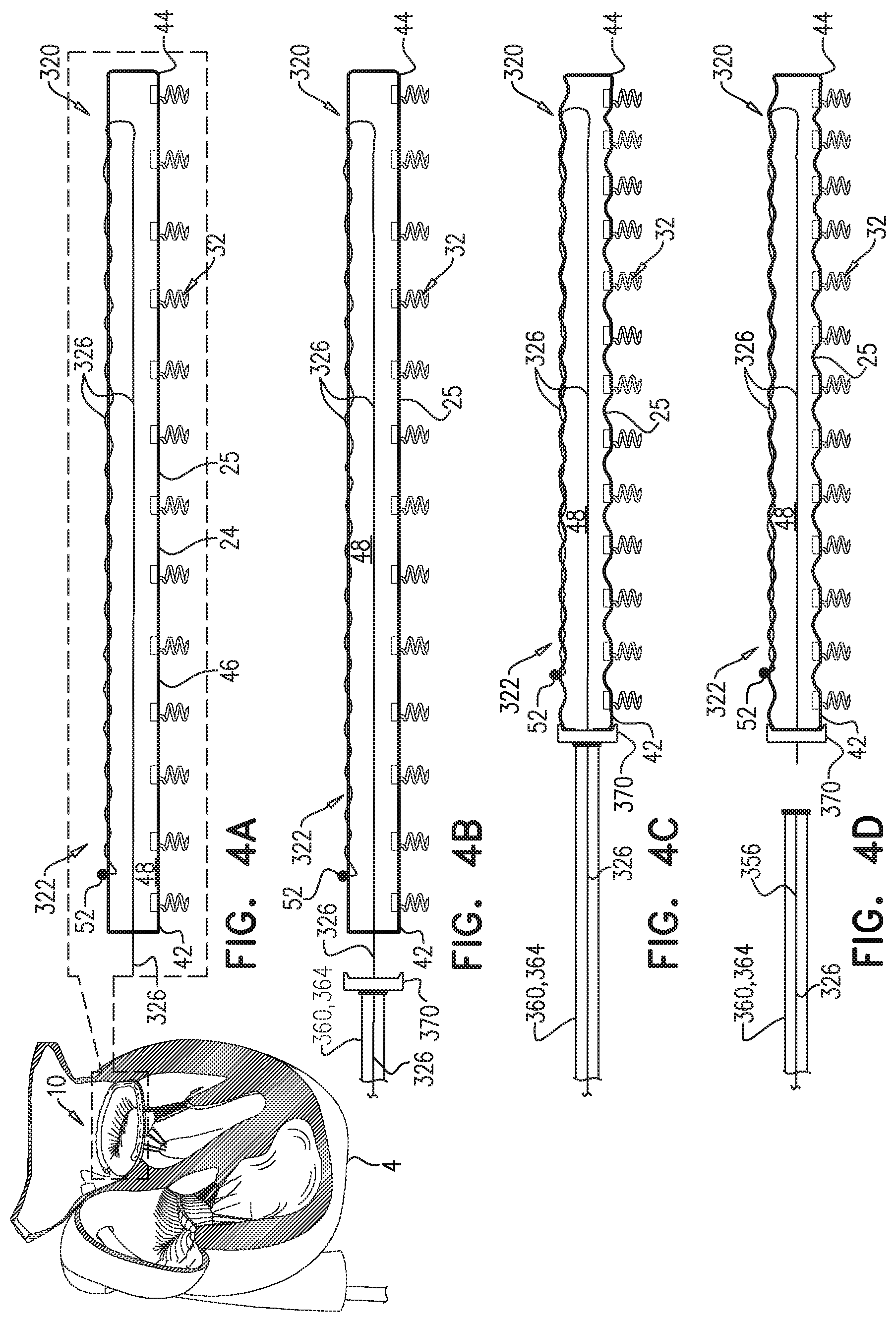 Patent US11779463 Figure 4 – Contraction of an annuloplasty structure