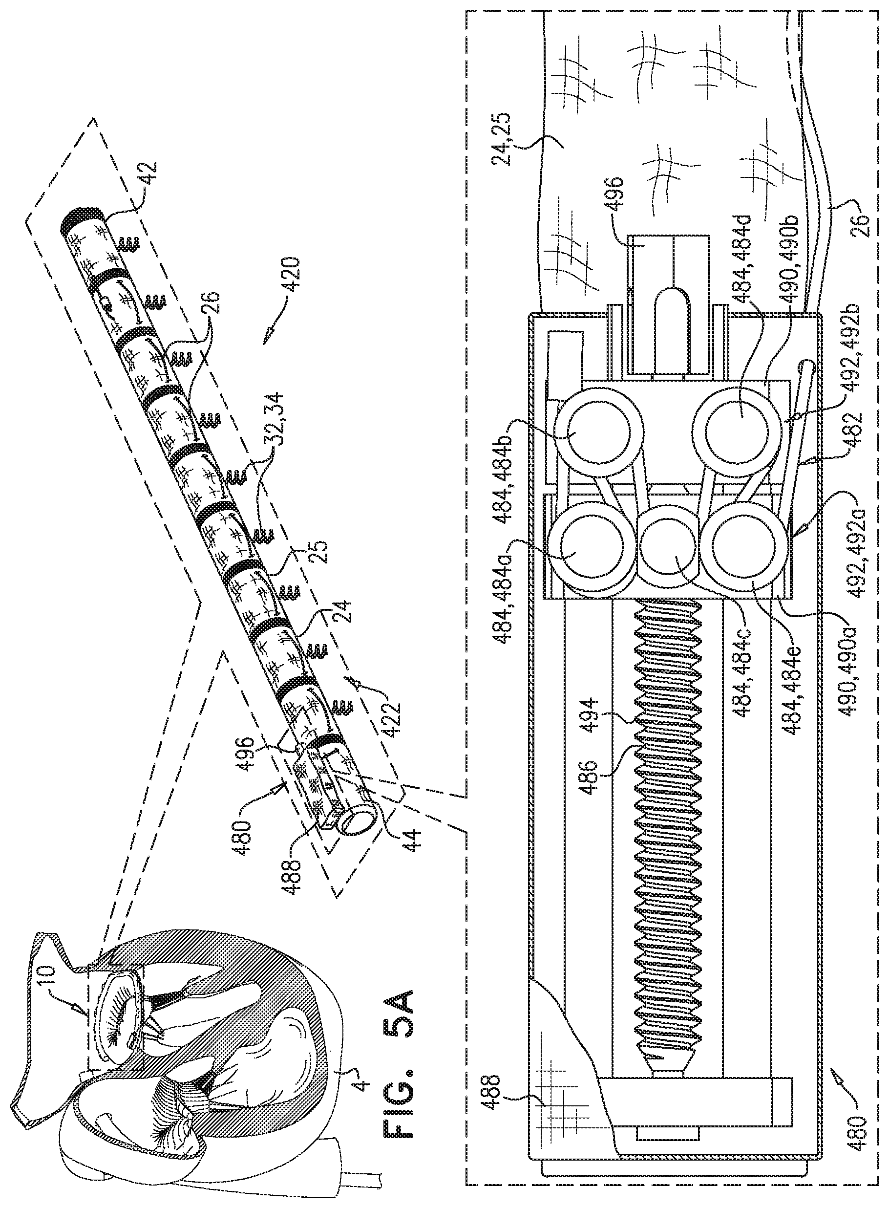 Patent US11779463 Figure 5 – Contraction of an annuloplasty structure