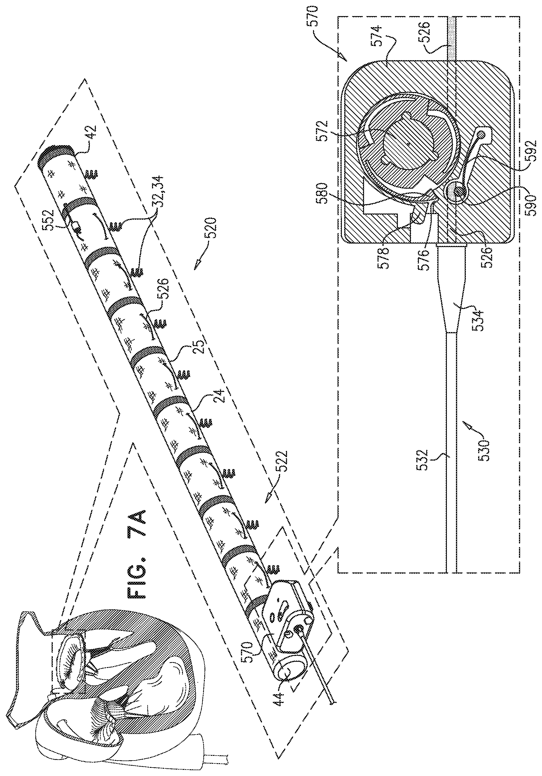 Patent US11779463 Figure 10 – Contraction of an annuloplasty structure