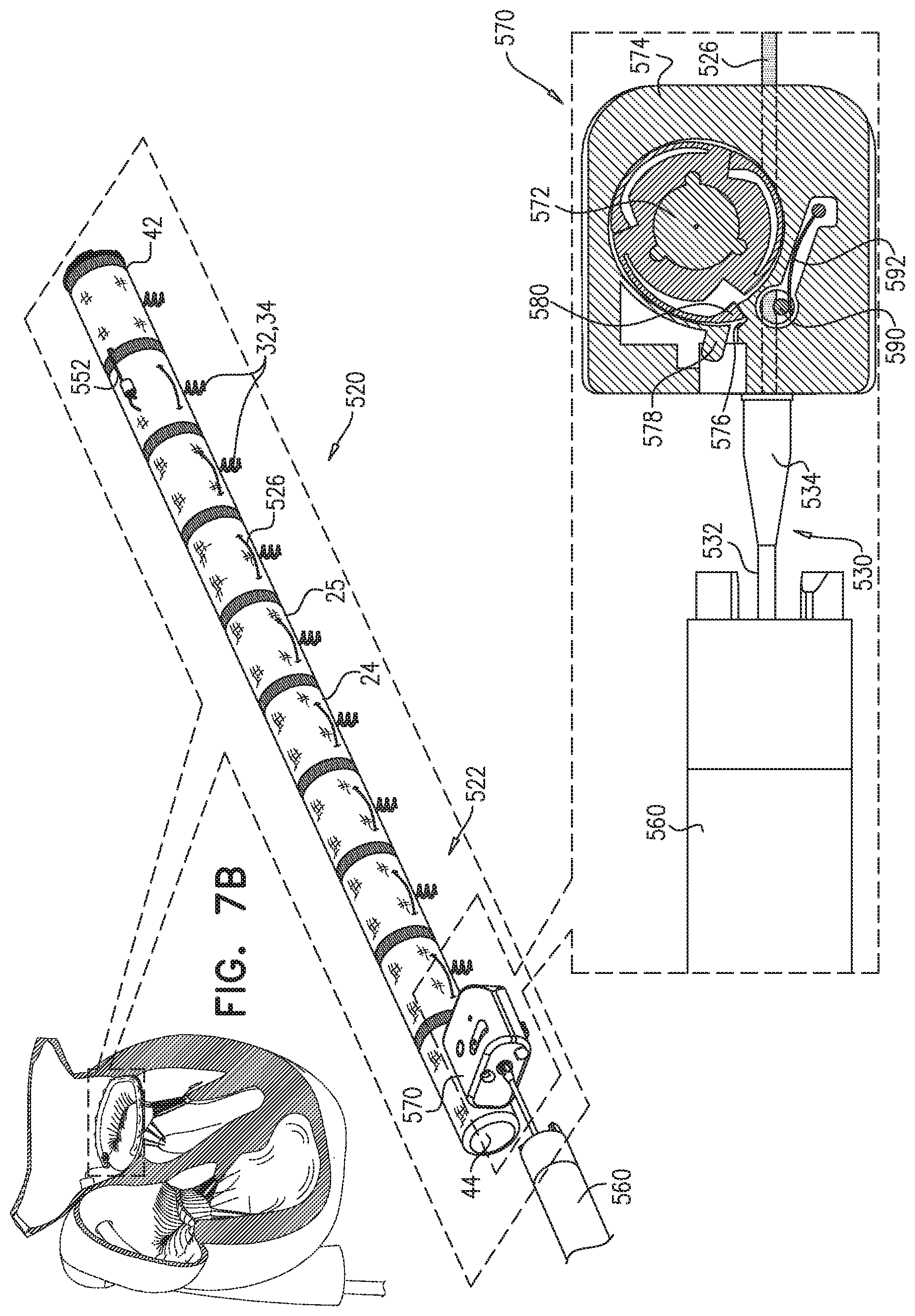 Patent US11779463 Figure 11 – Contraction of an annuloplasty structure