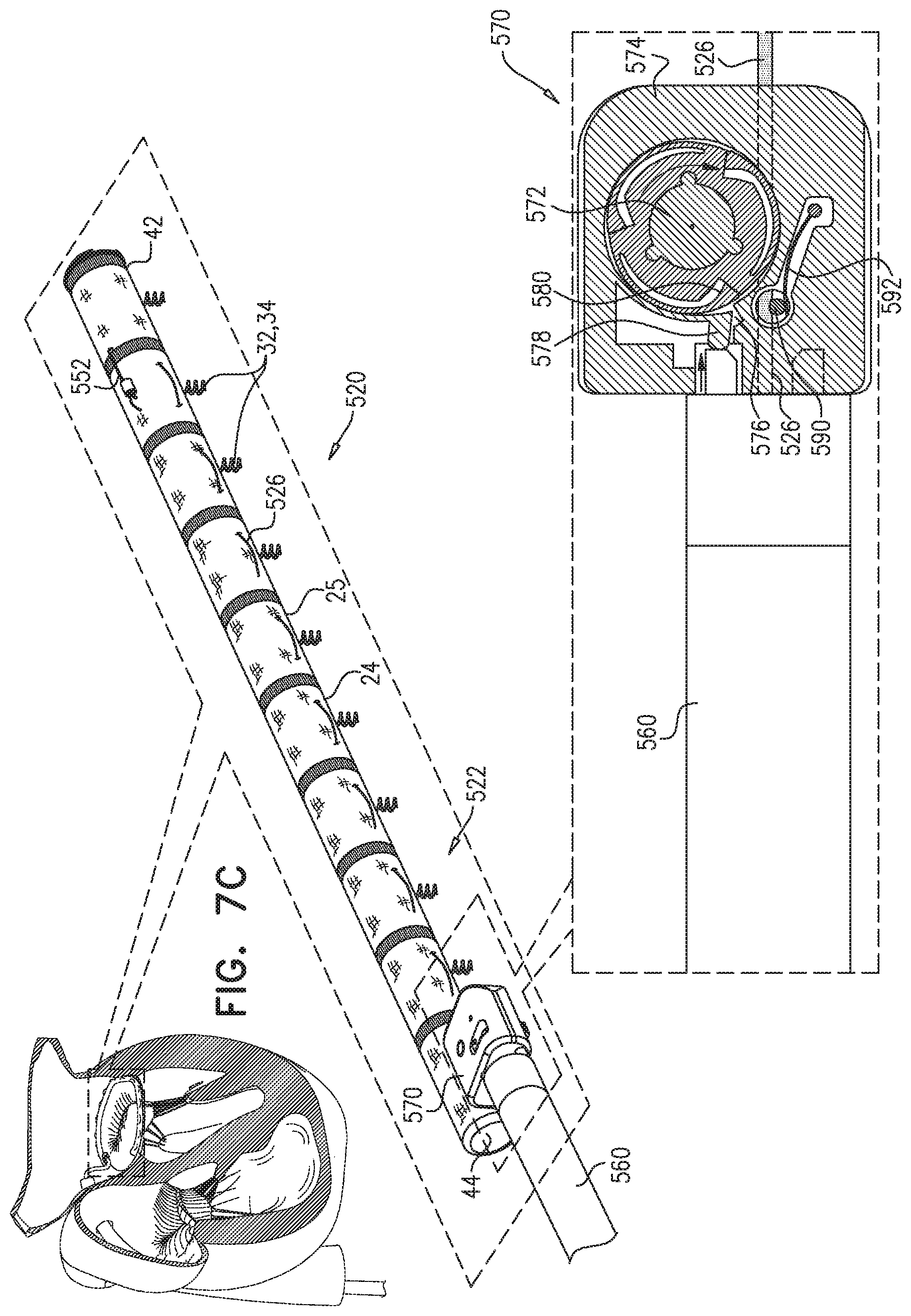 Patent US11779463 Figure 12 – Contraction of an annuloplasty structure