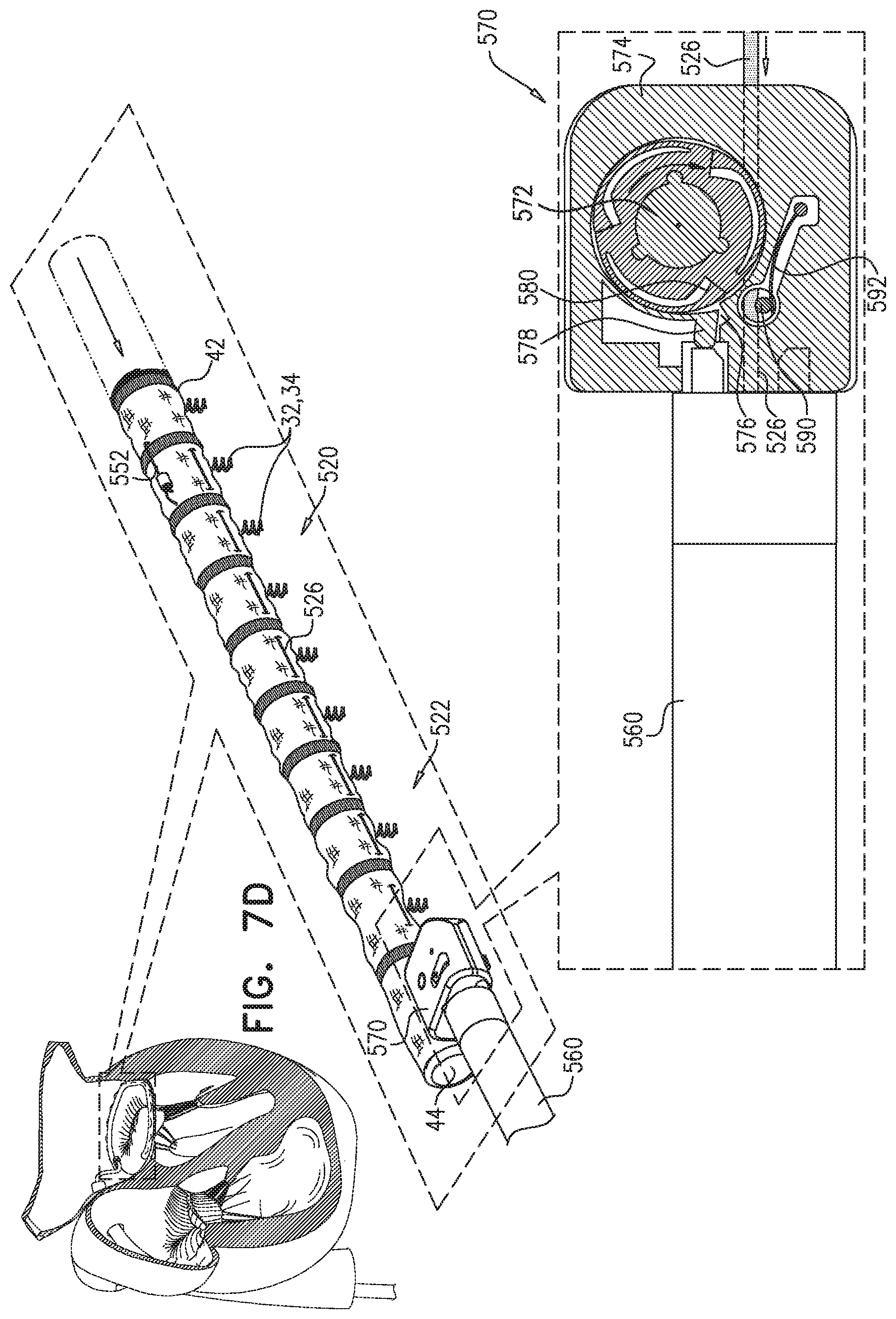Patent US11779463 Figure 13 – Contraction of an annuloplasty structure