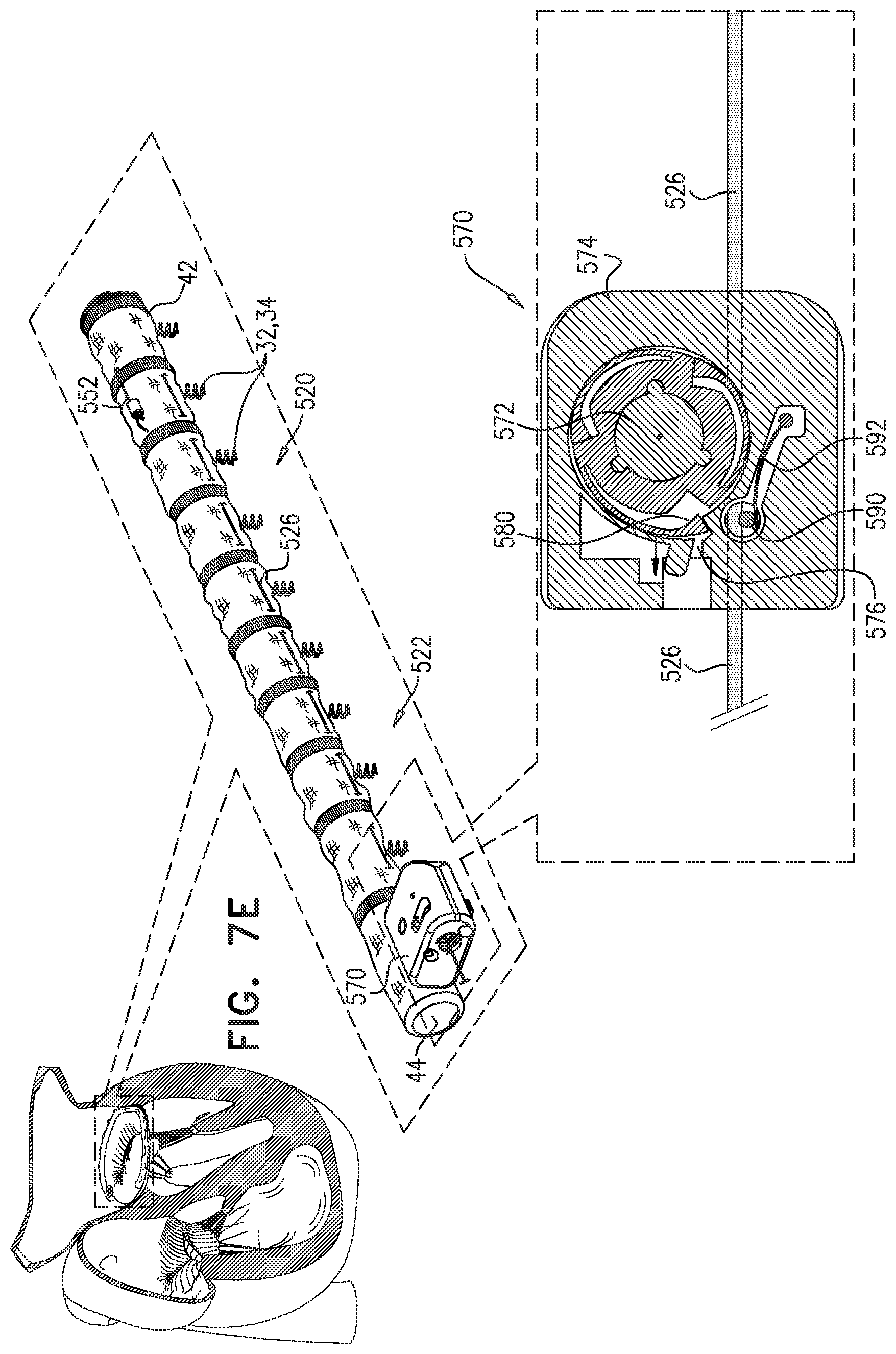Patent US11779463 Figure 14 – Contraction of an annuloplasty structure