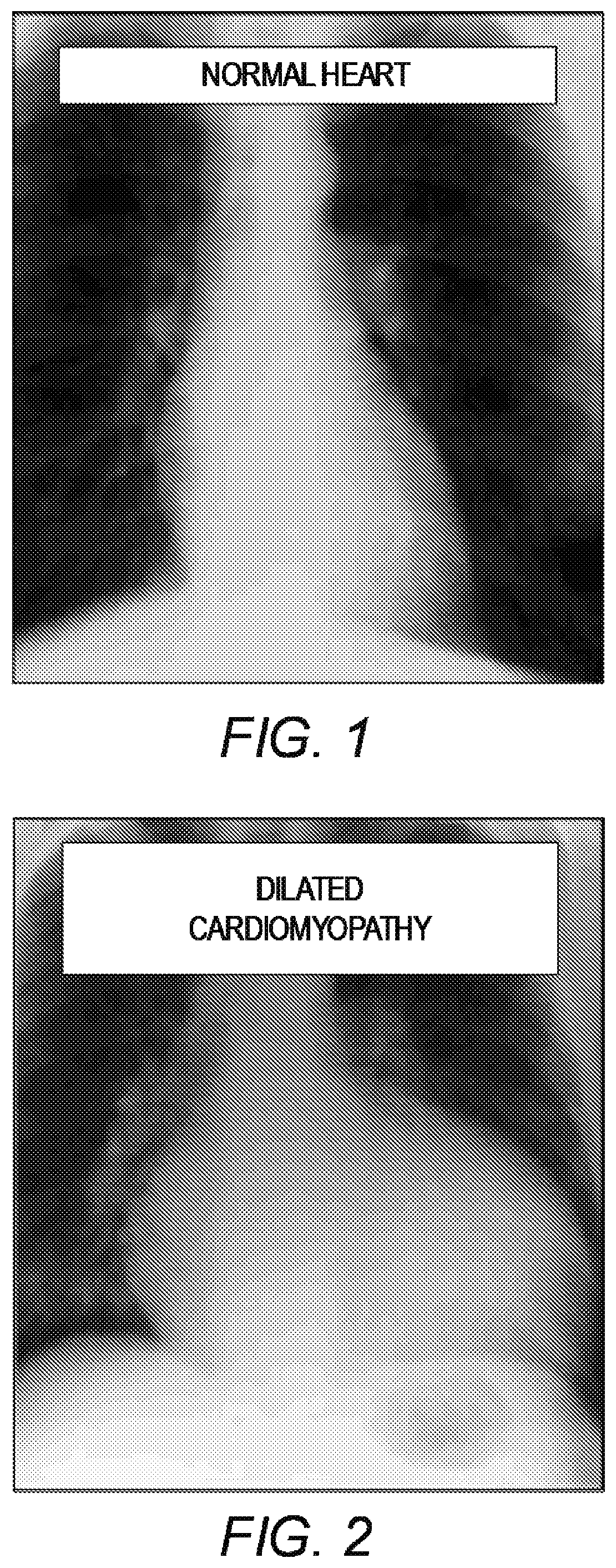 Patent US11779464 Figure 1 – Customized ventricular support device