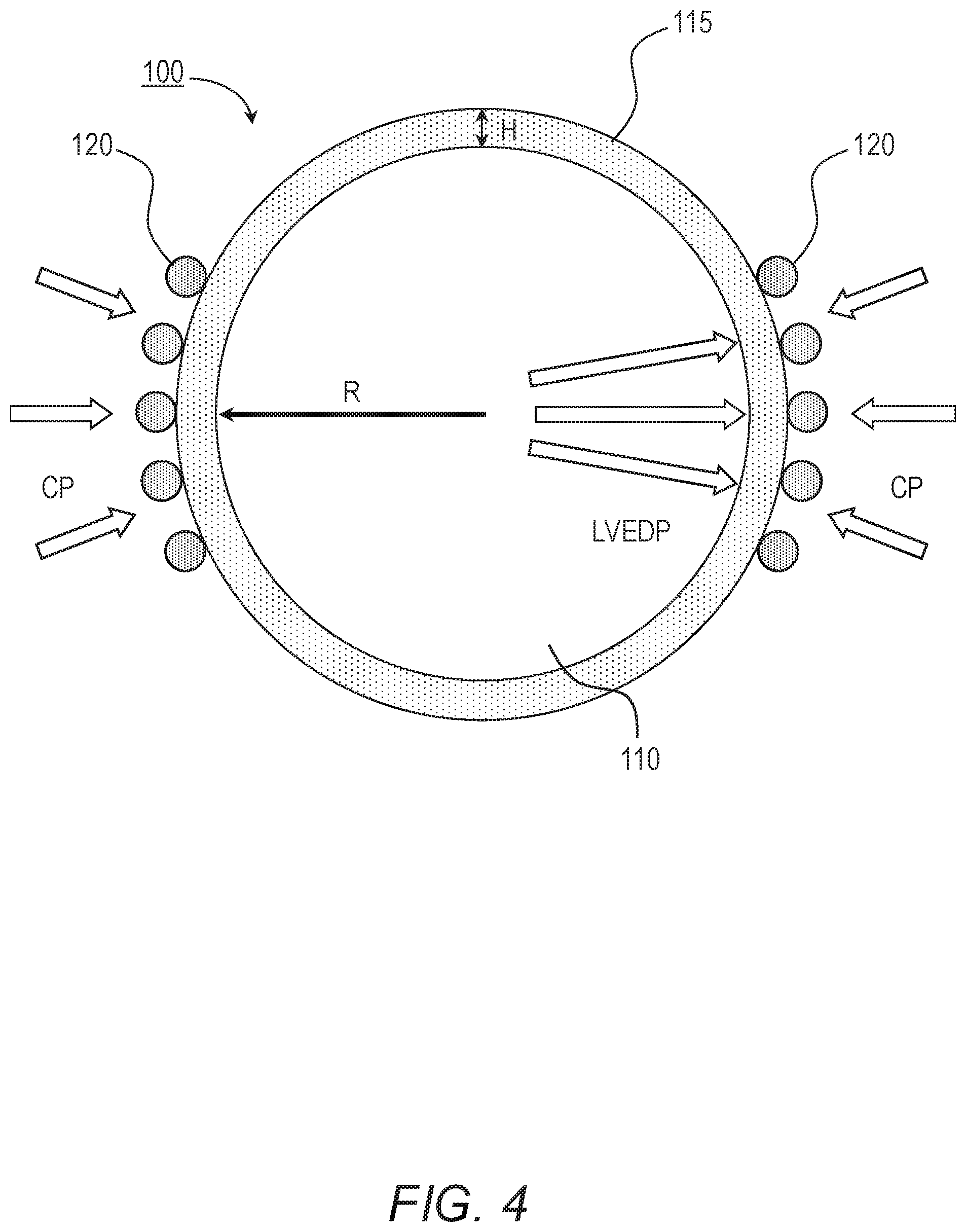Patent US11779464 Figure 3 – Customized ventricular support device