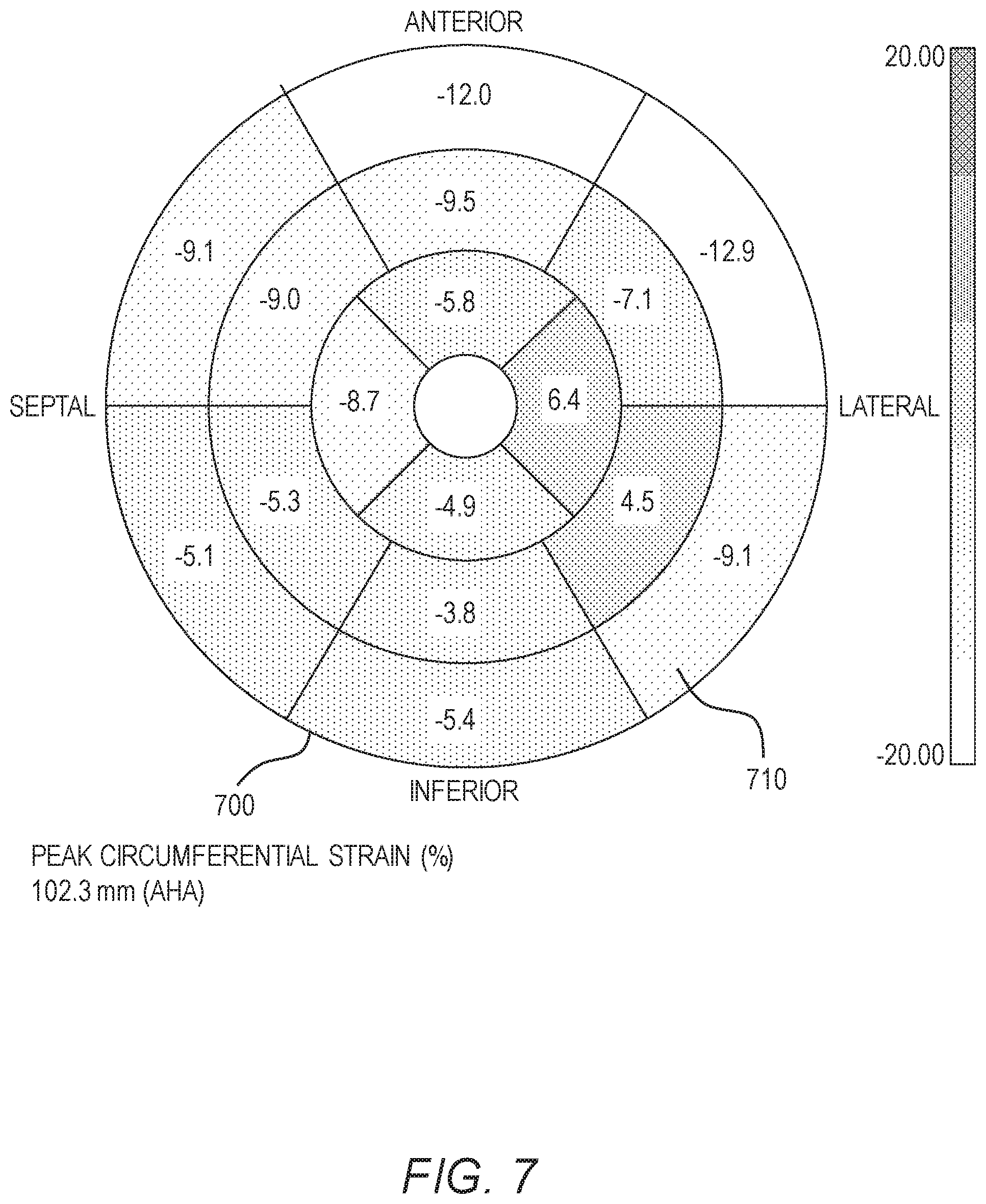 Patent US11779464 Figure 6 – Customized ventricular support device