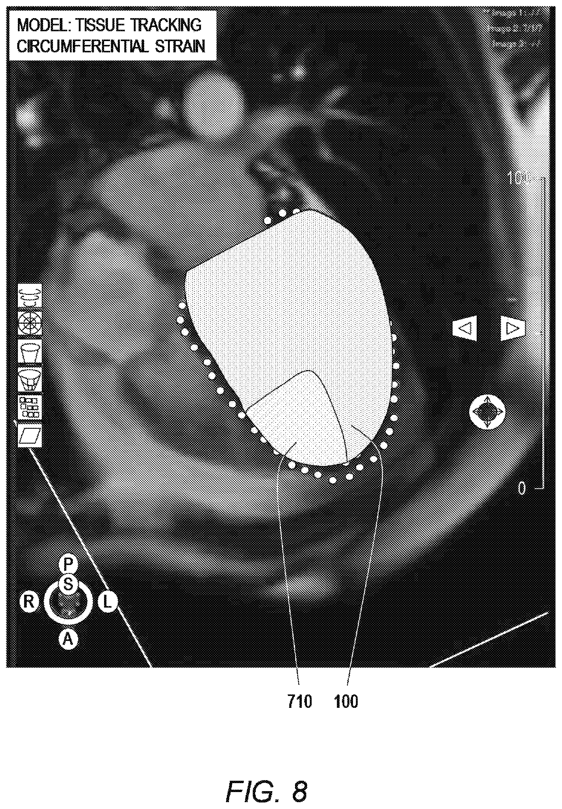 Patent US11779464 Figure 7 – Customized ventricular support device