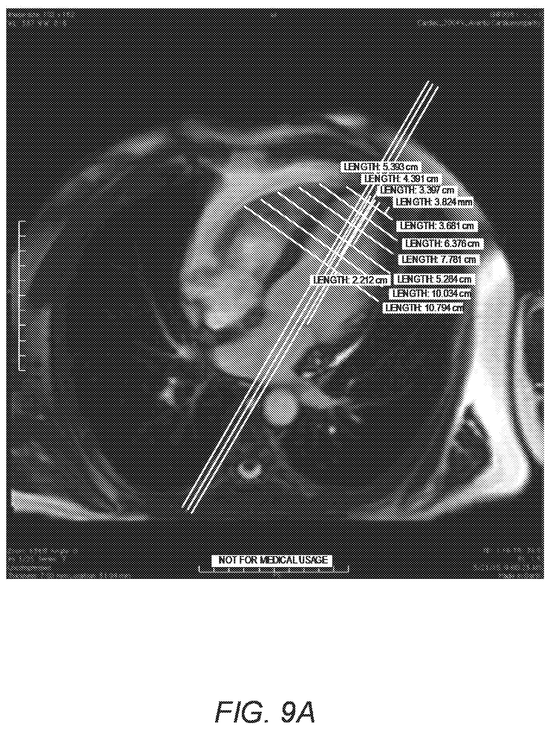 Patent US11779464 Figure 8 – Customized ventricular support device