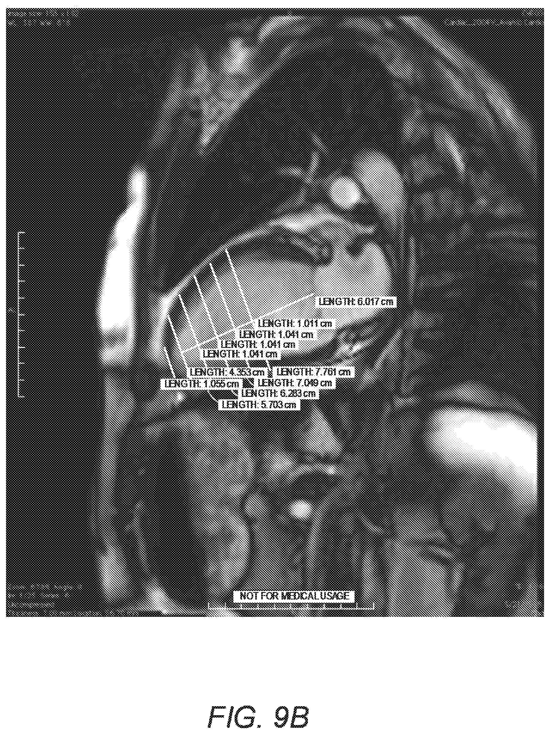 Patent US11779464 Figure 9 – Customized ventricular support device