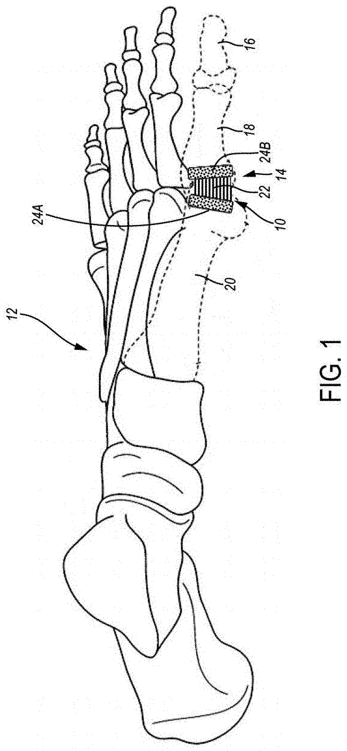 Patent US11779467 Figure 1 – Metarsophalangeal joint replacement device and methods