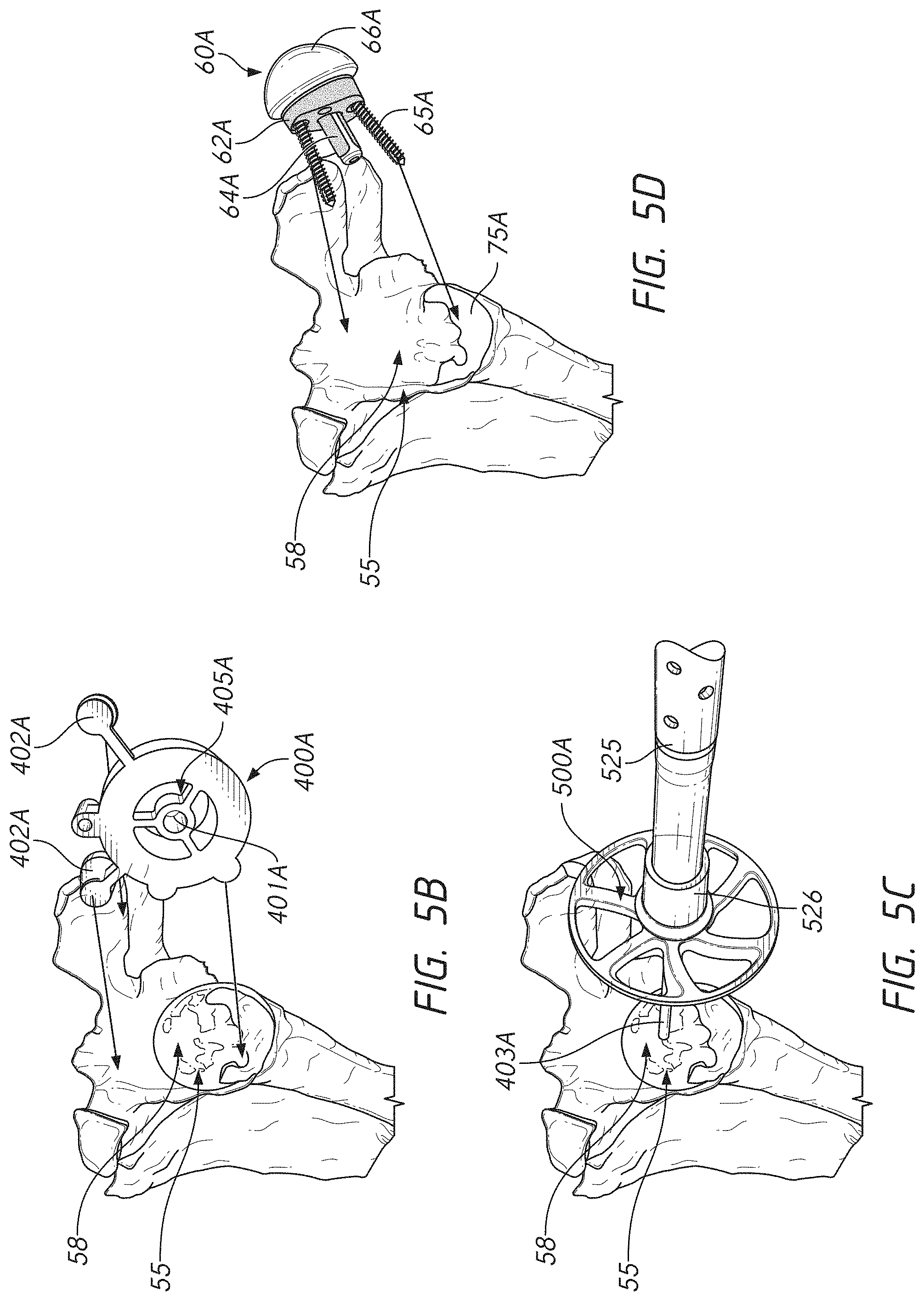 Patent US11779471 Figure 11 – Apparatuses and methods for implanting glenoid prostheses