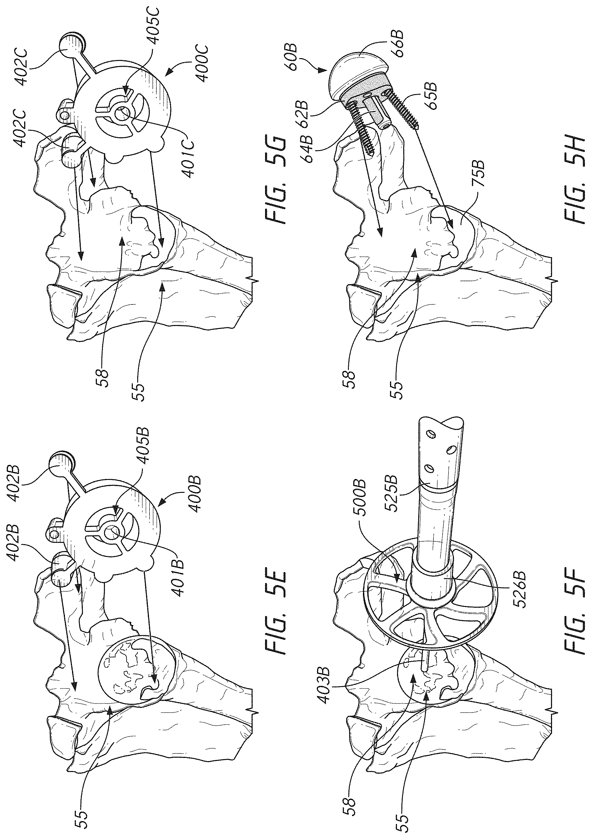 Patent US11779471 Figure 12 – Apparatuses and methods for implanting glenoid prostheses