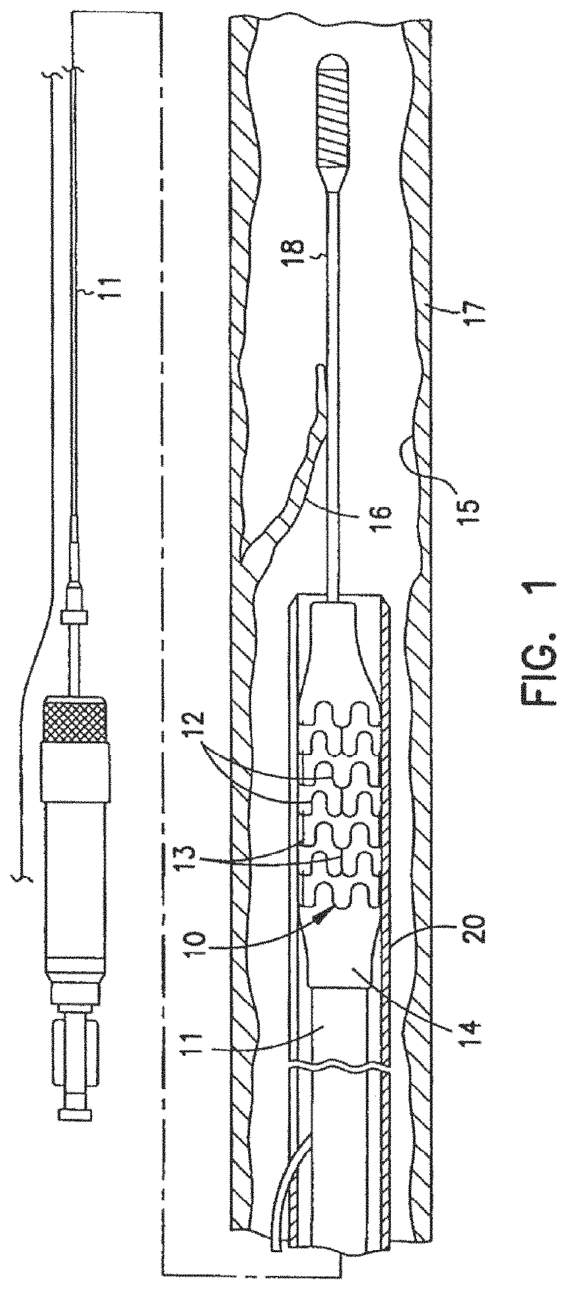 Patent US11779477 Figure 1 – Radiopaque intraluminal stents