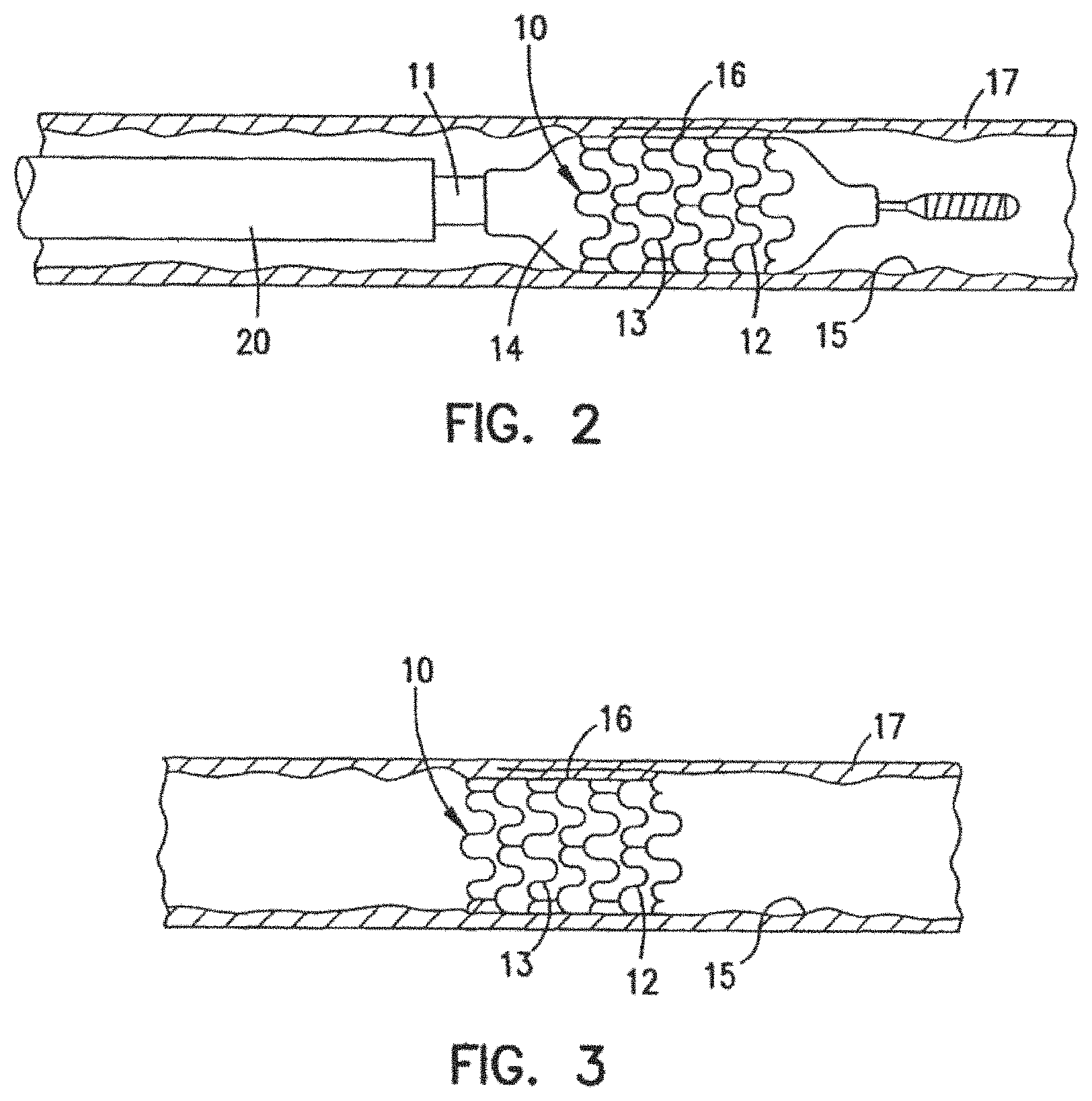 Patent US11779477 Figure 2 – Radiopaque intraluminal stents