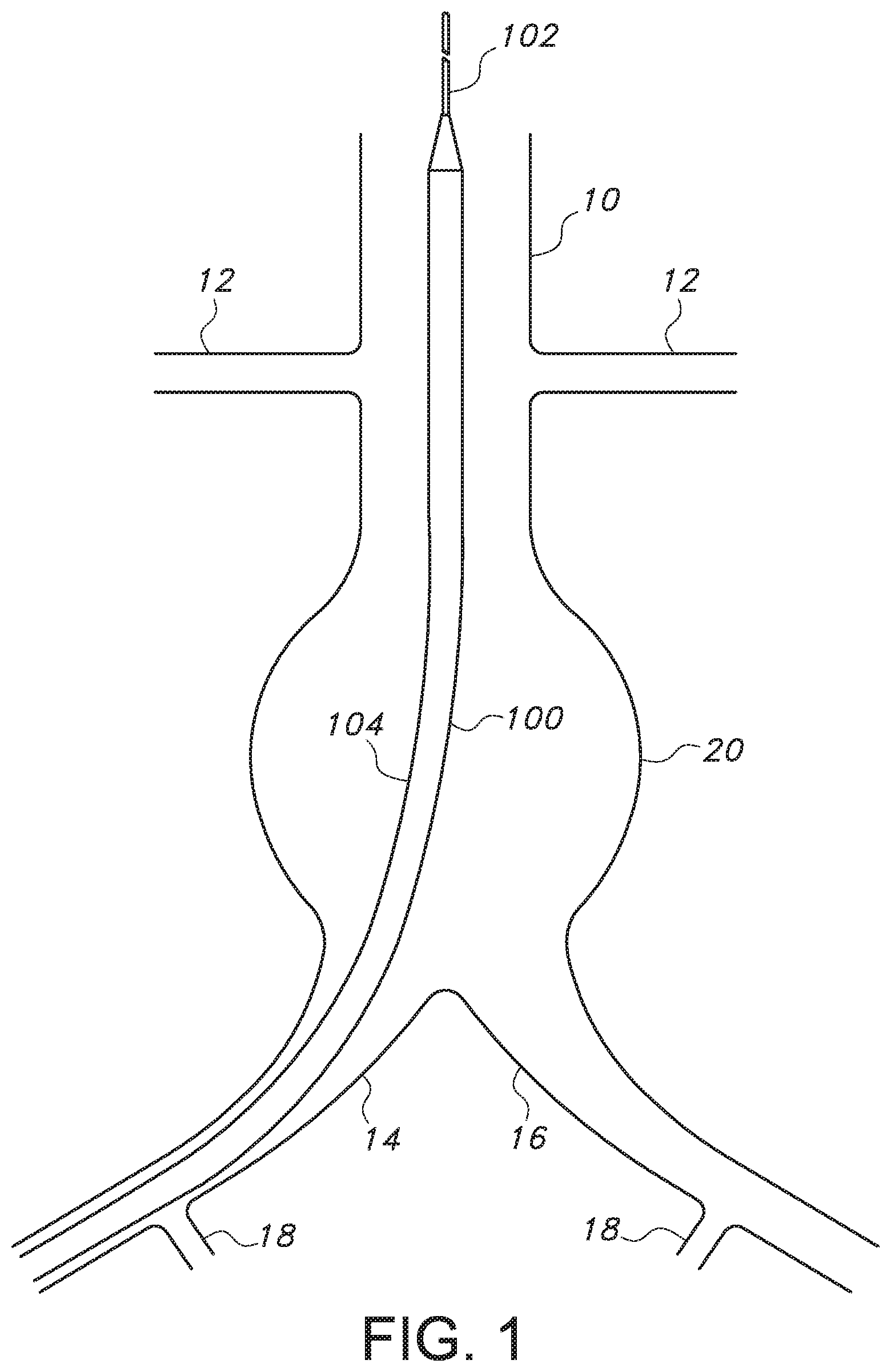 Patent US11779479 Figure 1 – Bifurcated endovascular prosthesis having tethered contralateral leg