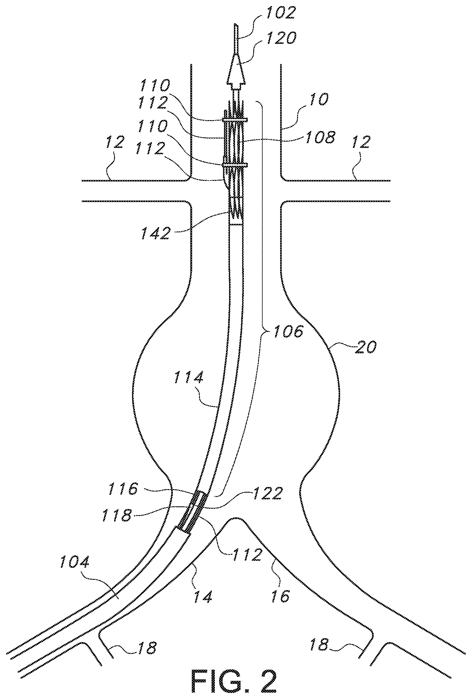 Patent US11779479 Figure 2 – Bifurcated endovascular prosthesis having tethered contralateral leg