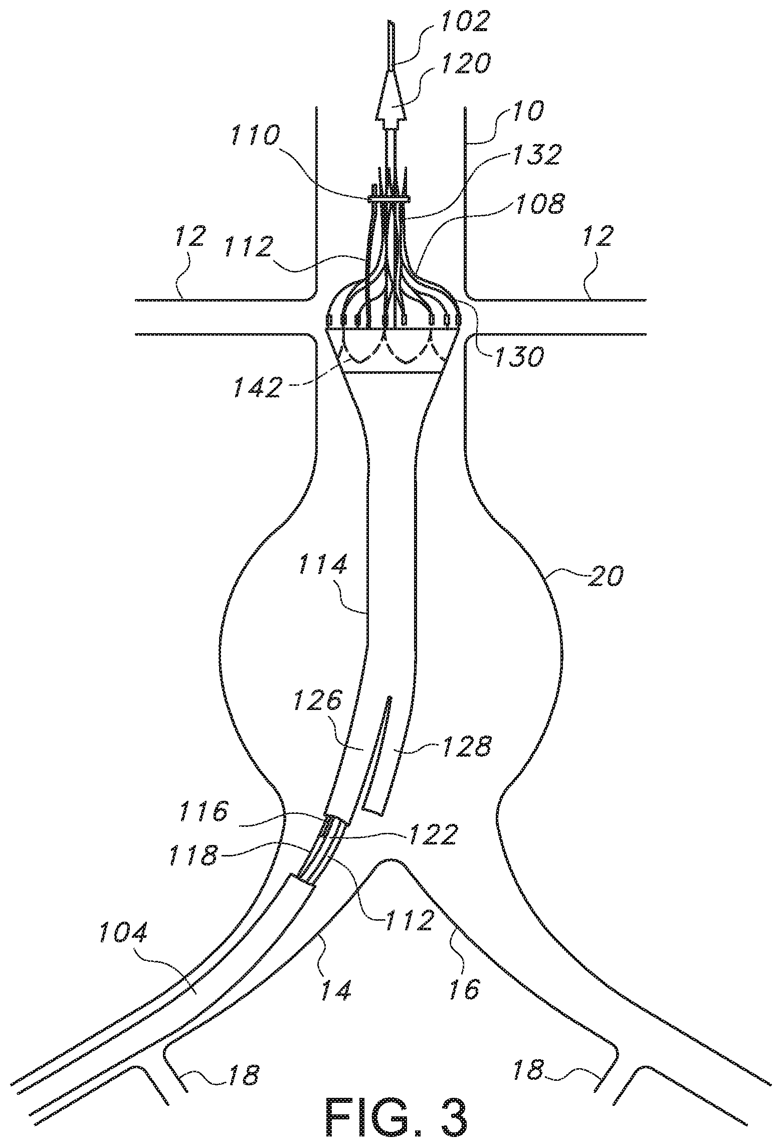 Patent US11779479 Figure 3 – Bifurcated endovascular prosthesis having tethered contralateral leg