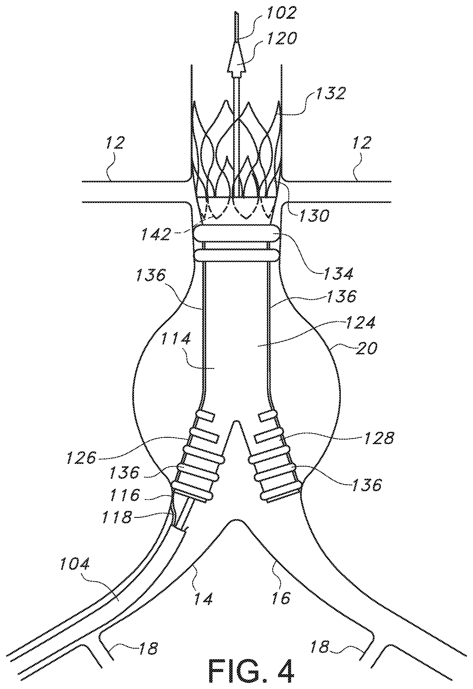 Patent US11779479 Figure 4 – Bifurcated endovascular prosthesis having tethered contralateral leg