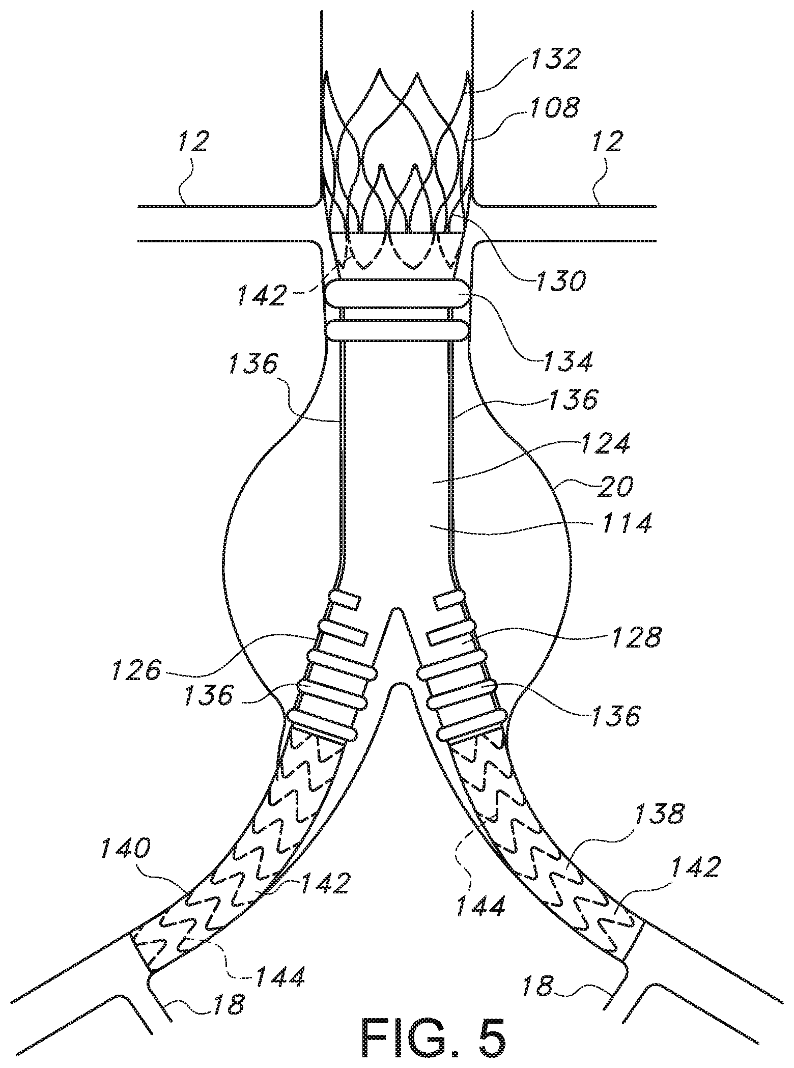 Patent US11779479 Figure 5 – Bifurcated endovascular prosthesis having tethered contralateral leg
