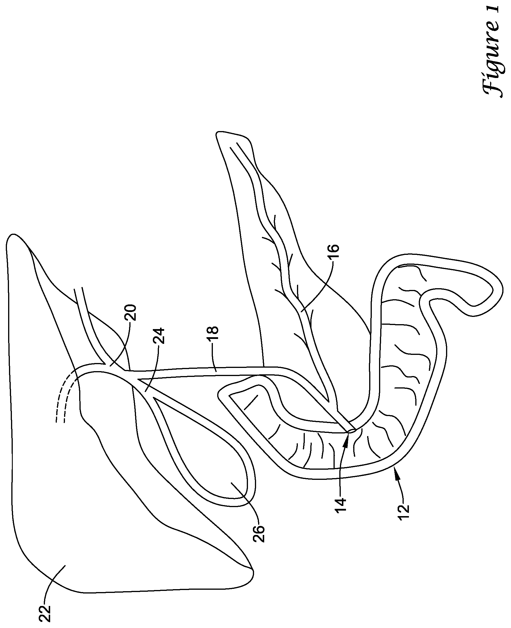 Patent US11779480 Figure 1 – Medical devices for use along the biliary and/or pancreatic tract