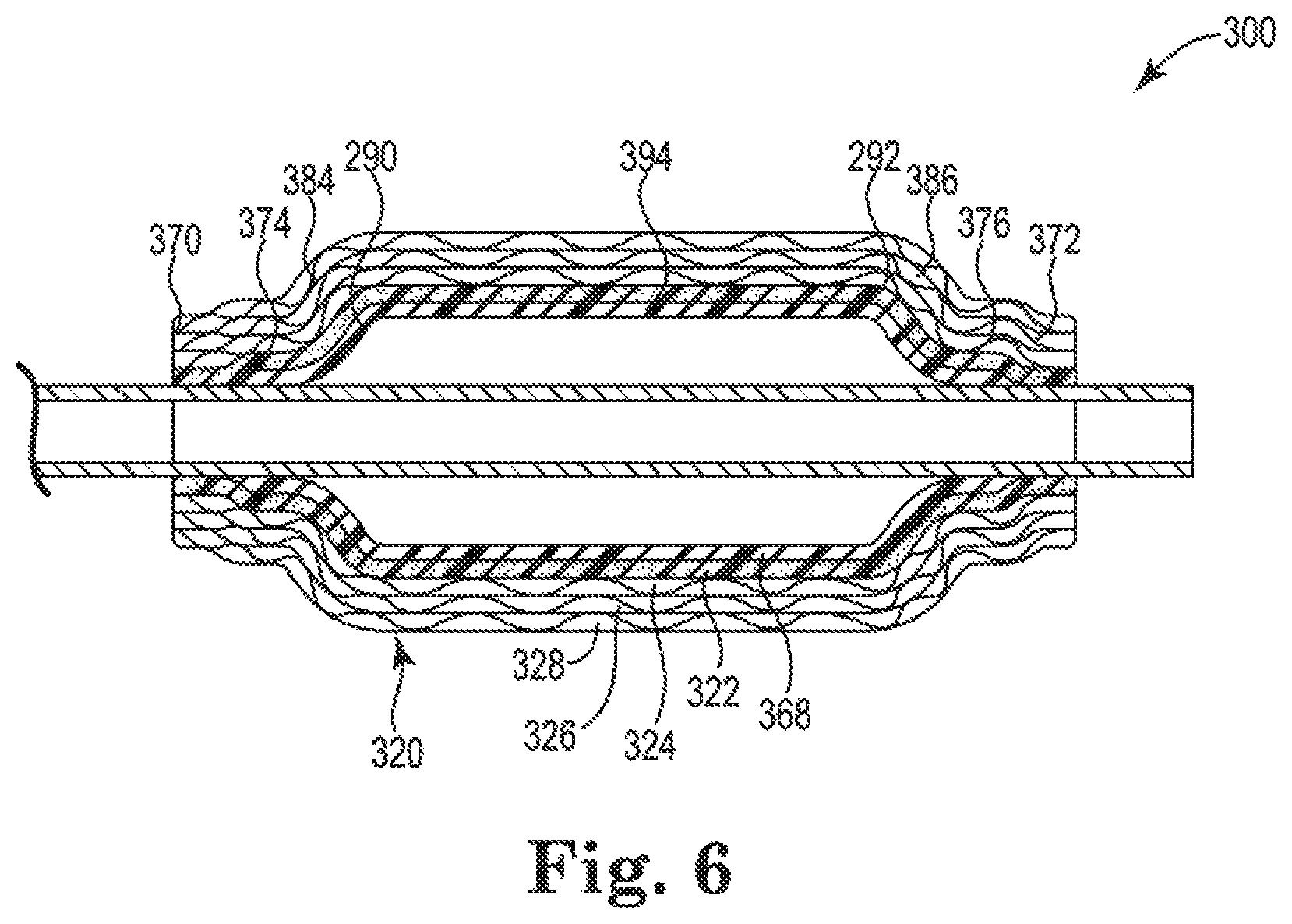 Patent US11779481 Figure 7 – Controlled endoprosthesis balloon expansion