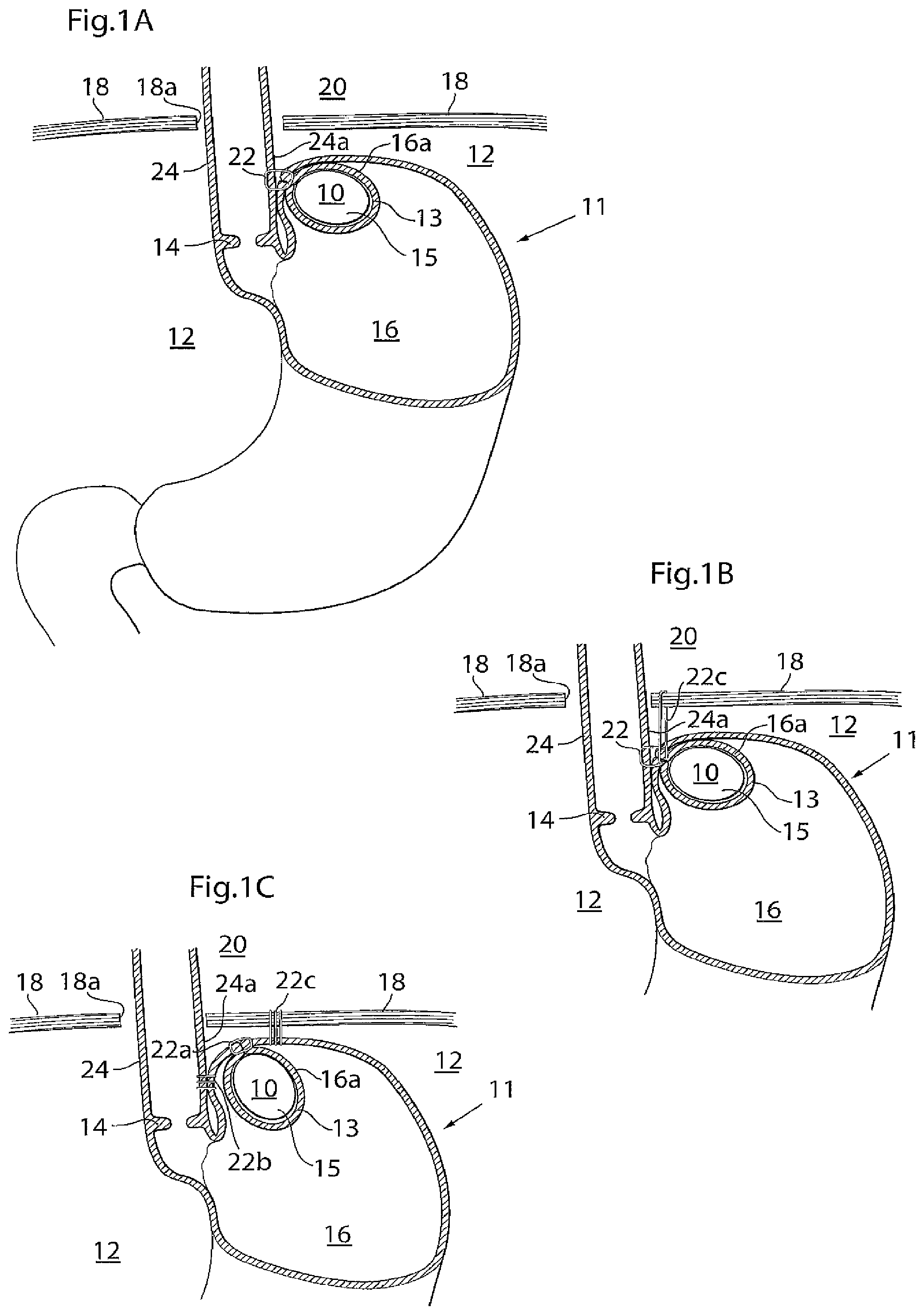 Patent US11779483 Figure 1 – Apparatus for treating GERD