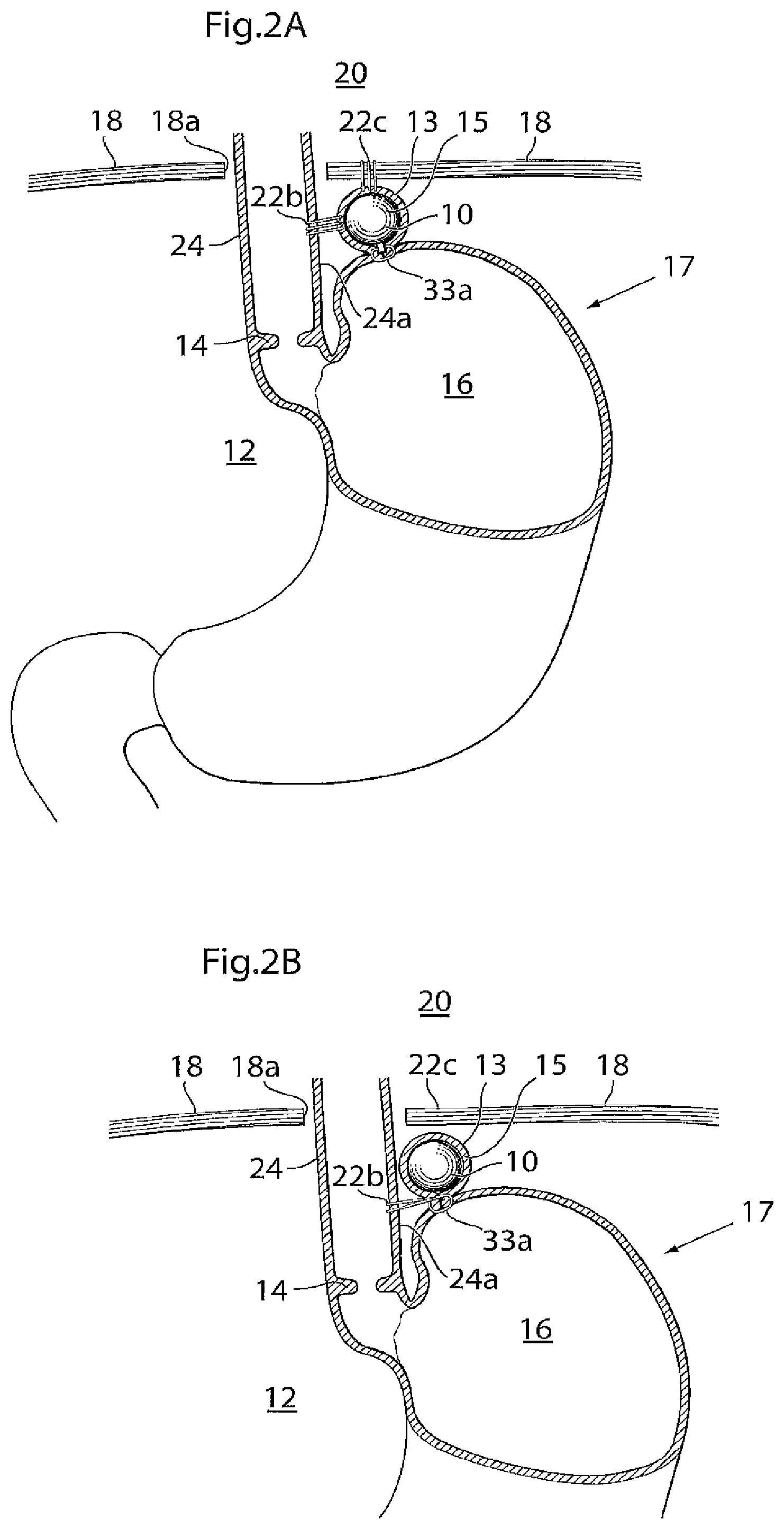 Patent US11779483 Figure 2 – Apparatus for treating GERD