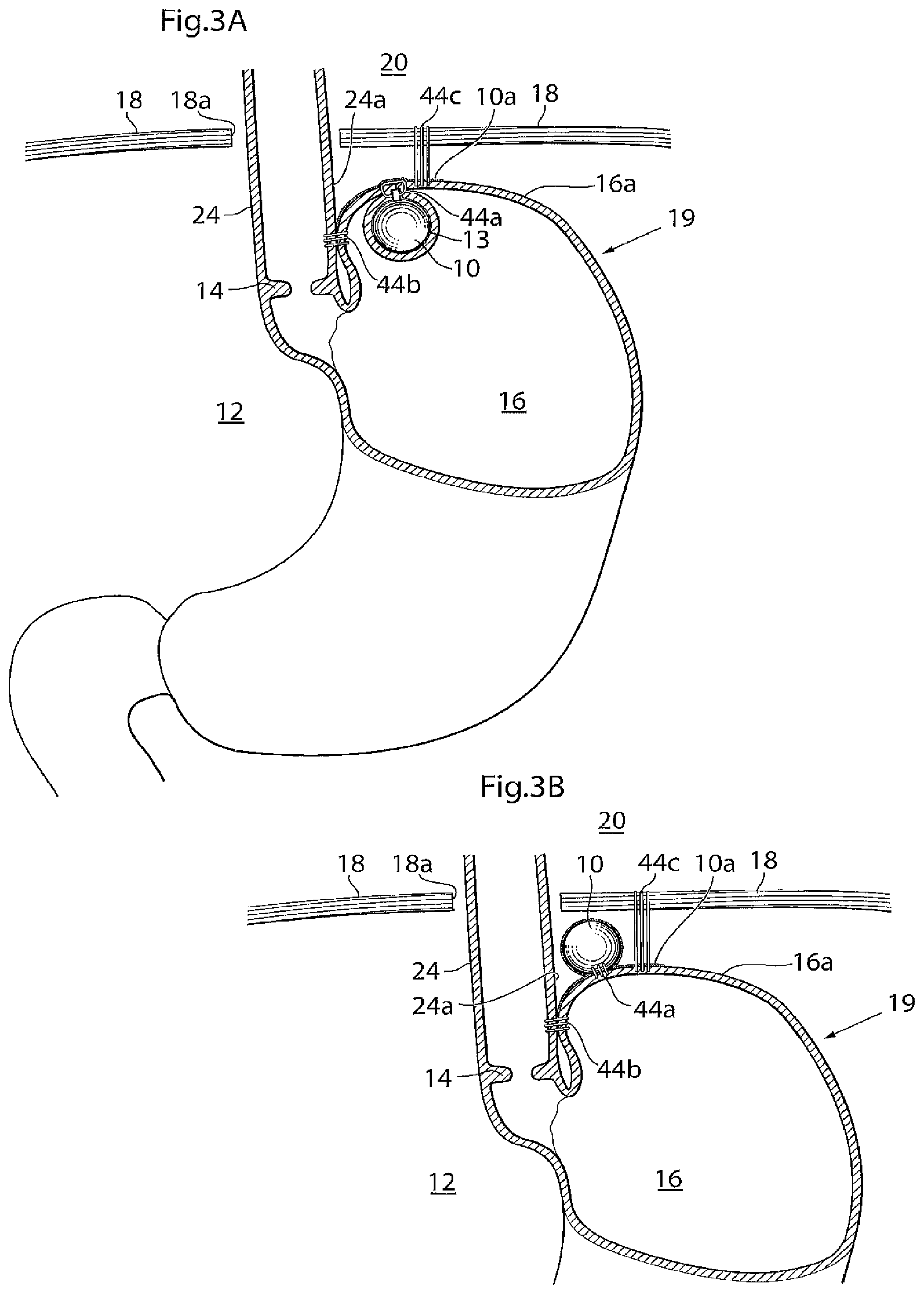 Patent US11779483 Figure 3 – Apparatus for treating GERD