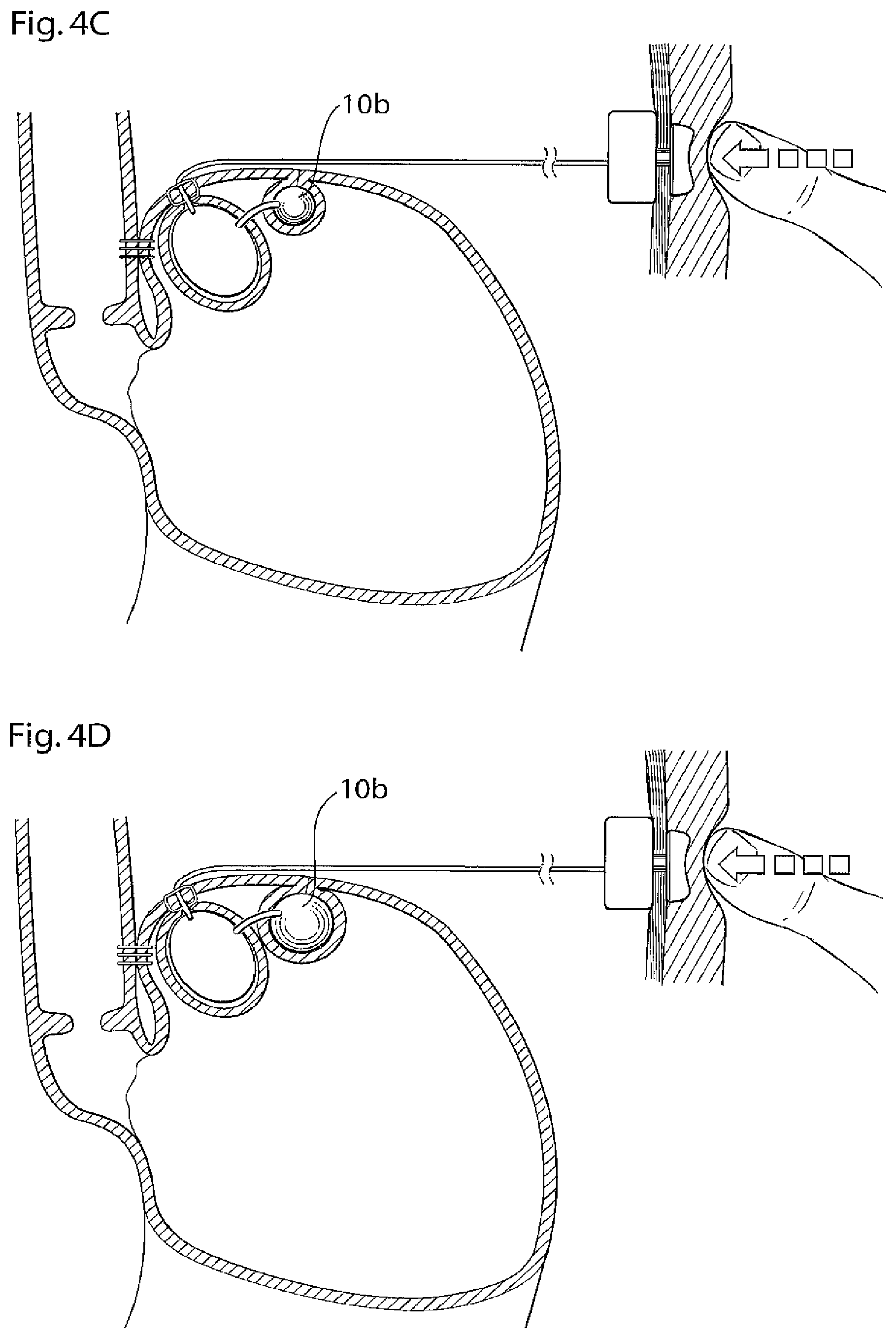 Patent US11779483 Figure 5 – Apparatus for treating GERD