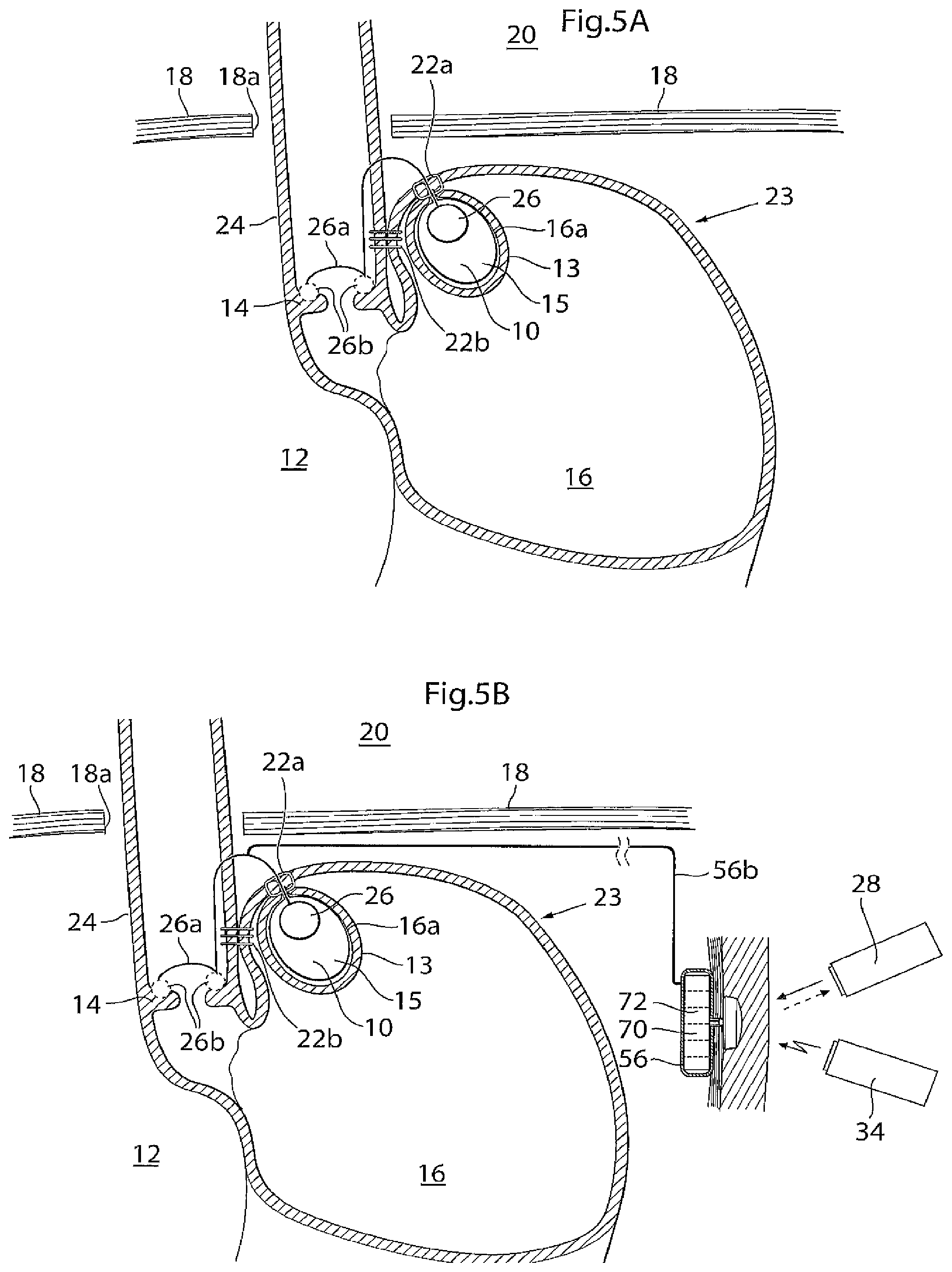 Patent US11779483 Figure 6 – Apparatus for treating GERD