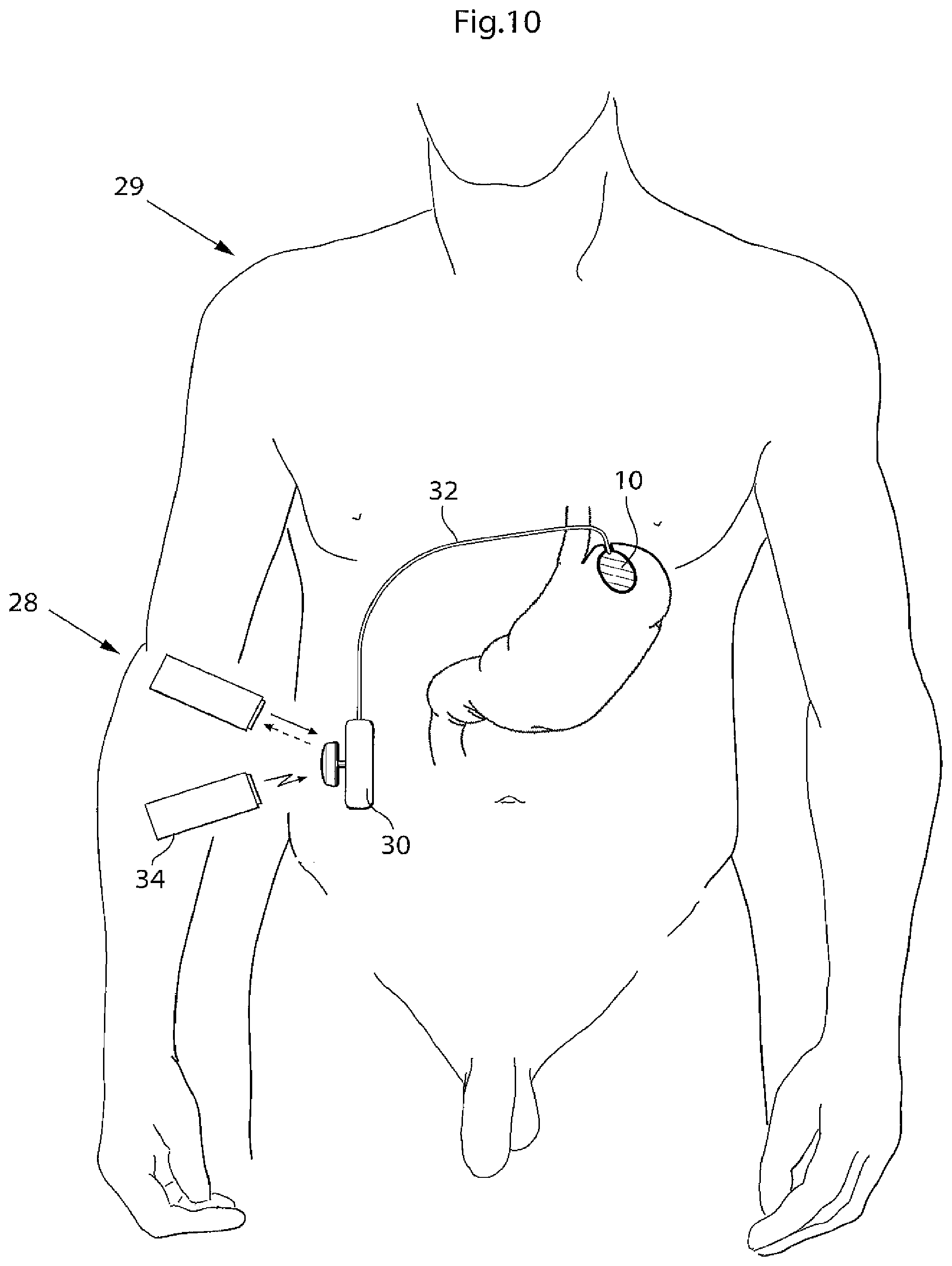 Patent US11779483 Figure 8 – Apparatus for treating GERD