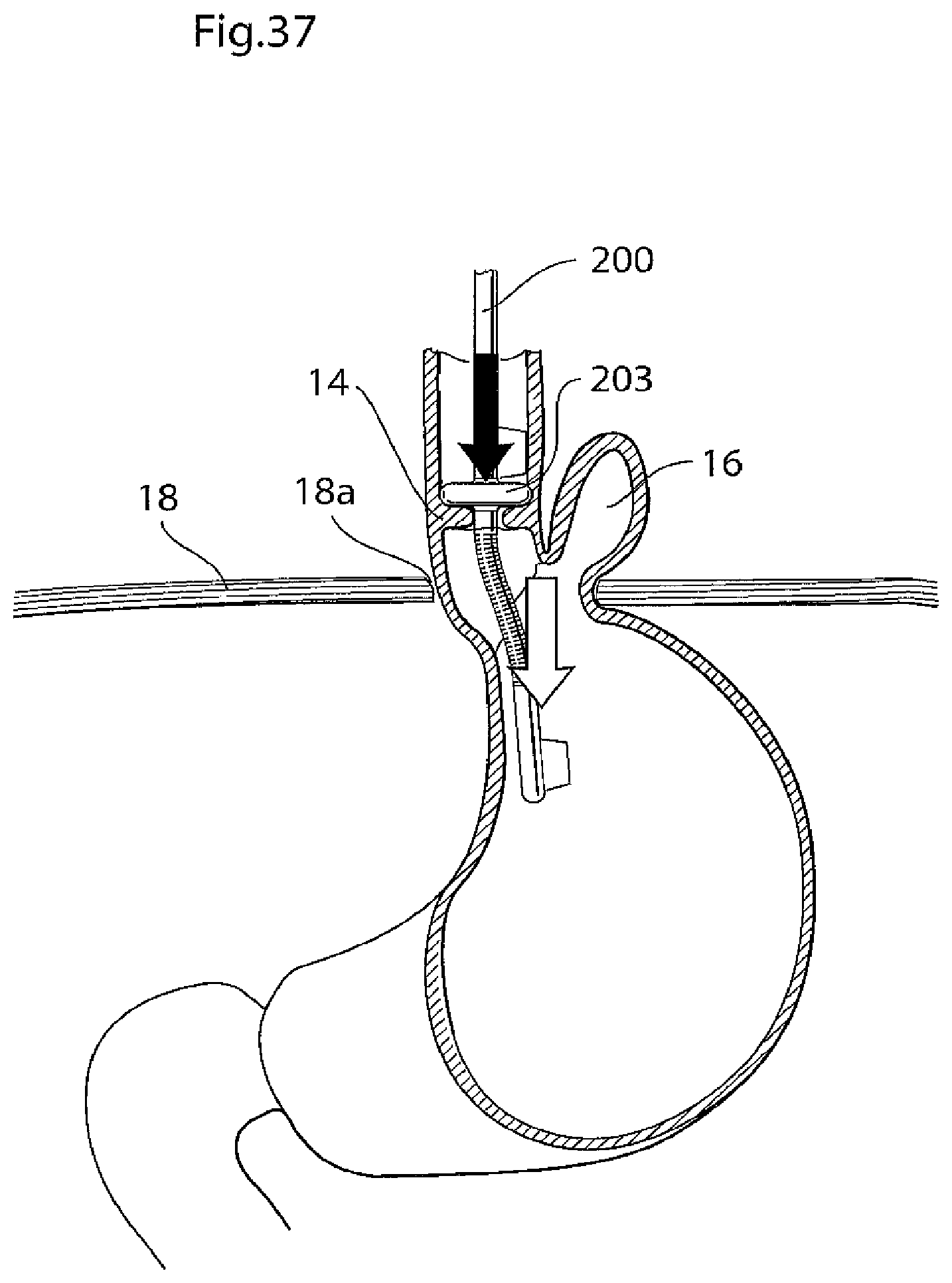 Patent US11779483 Figure 19 – Apparatus for treating GERD