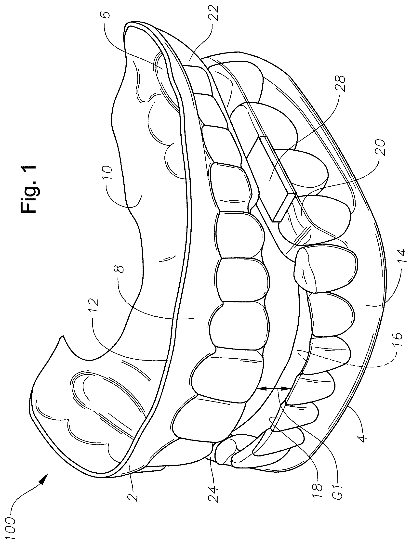 Patent US11779486 Figure 1 – Mouth guards, kits, and methods