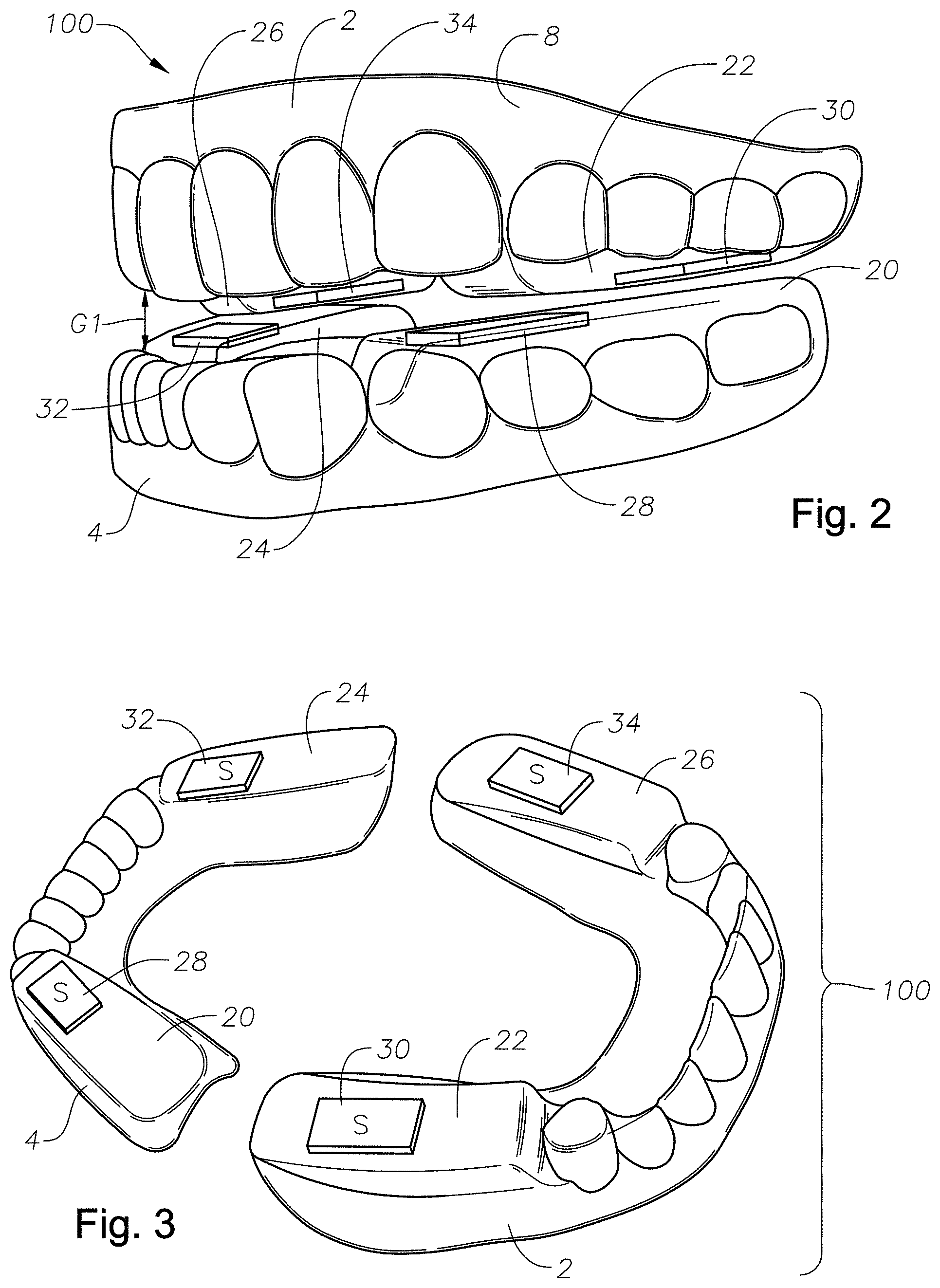 Patent US11779486 Figure 2 – Mouth guards, kits, and methods