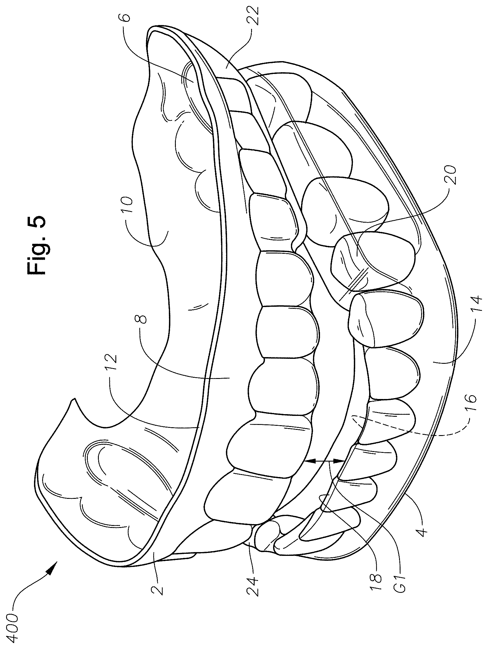 Patent US11779486 Figure 6 – Mouth guards, kits, and methods