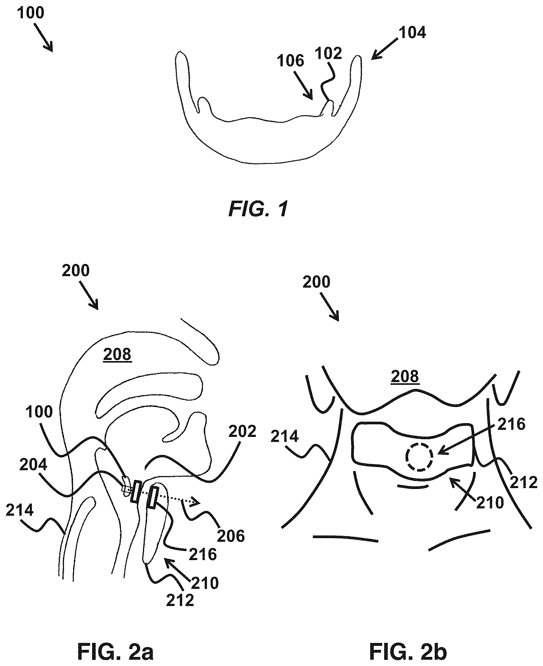 Patent US11779487 Figure 1 – Device and method for correcting obstructive sleep apnea