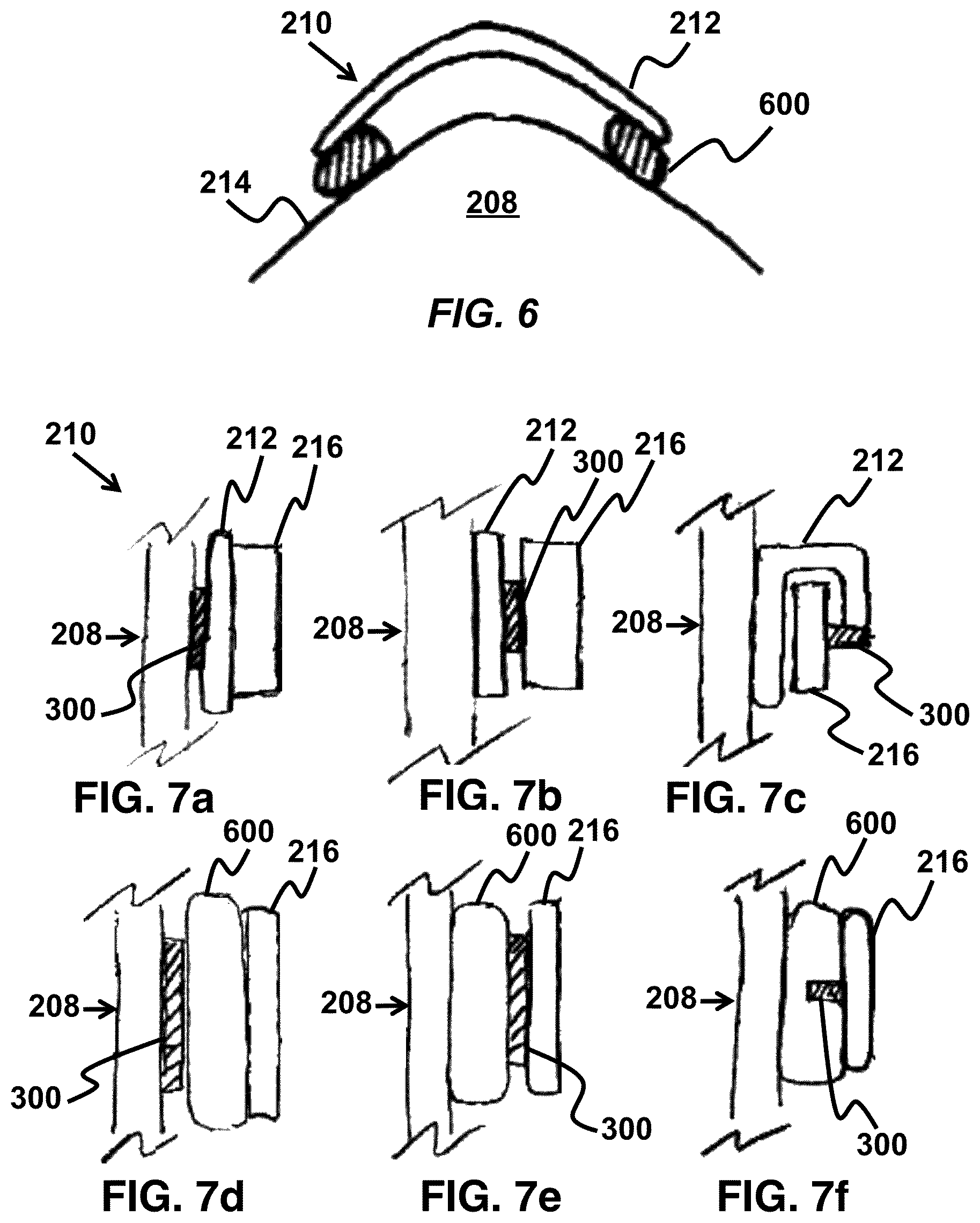 Patent US11779487 Figure 5 – Device and method for correcting obstructive sleep apnea