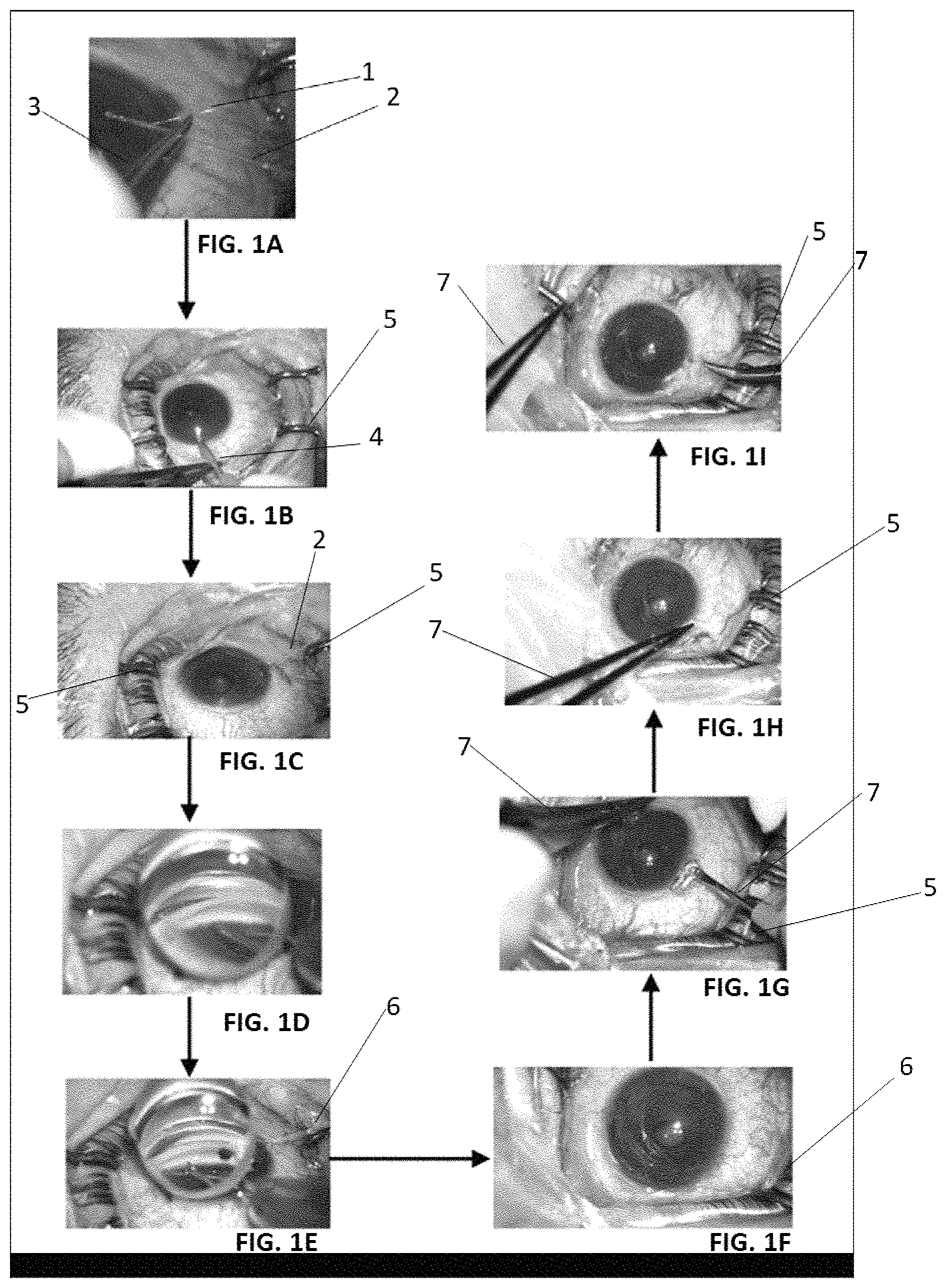 Patent US11779490 Figure 1 – Minimally invasive ab interno triple surgery for open-angle glaucoma
